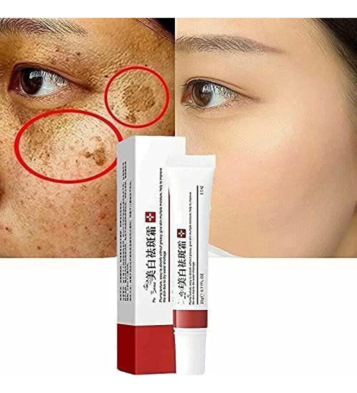 VoaiBekt Crema para Manchas Oscuras en La Cara Cremas para Quitar Manchas de La Cara - Buy Online on GoSupps.com