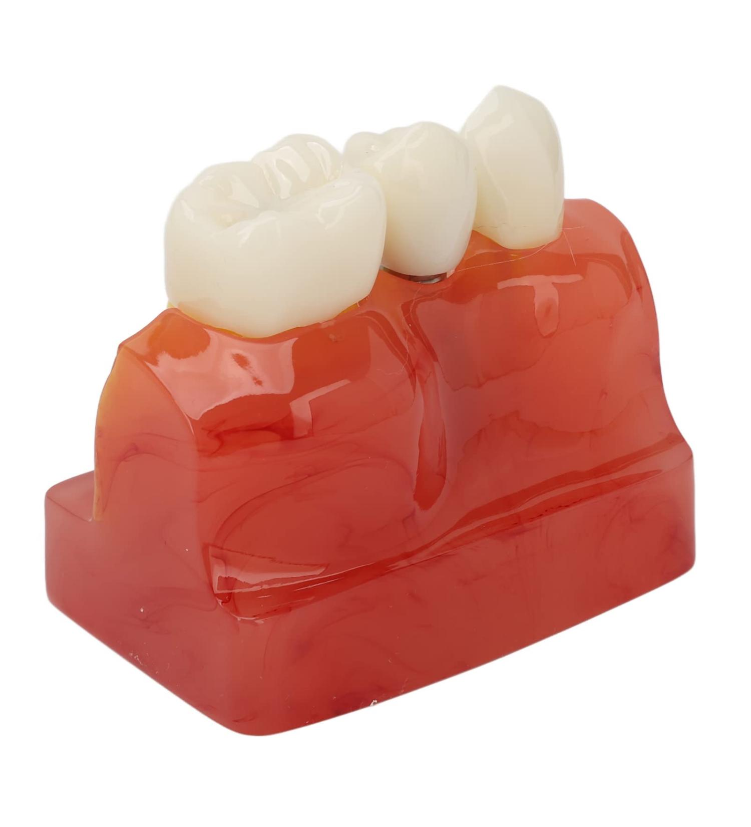 Verdant Touch Crown Bridge Demonstration Model - 4X Dental Implant Model for Doctor-Patient Education | International Shipping - Buy Online on GoSupps.com