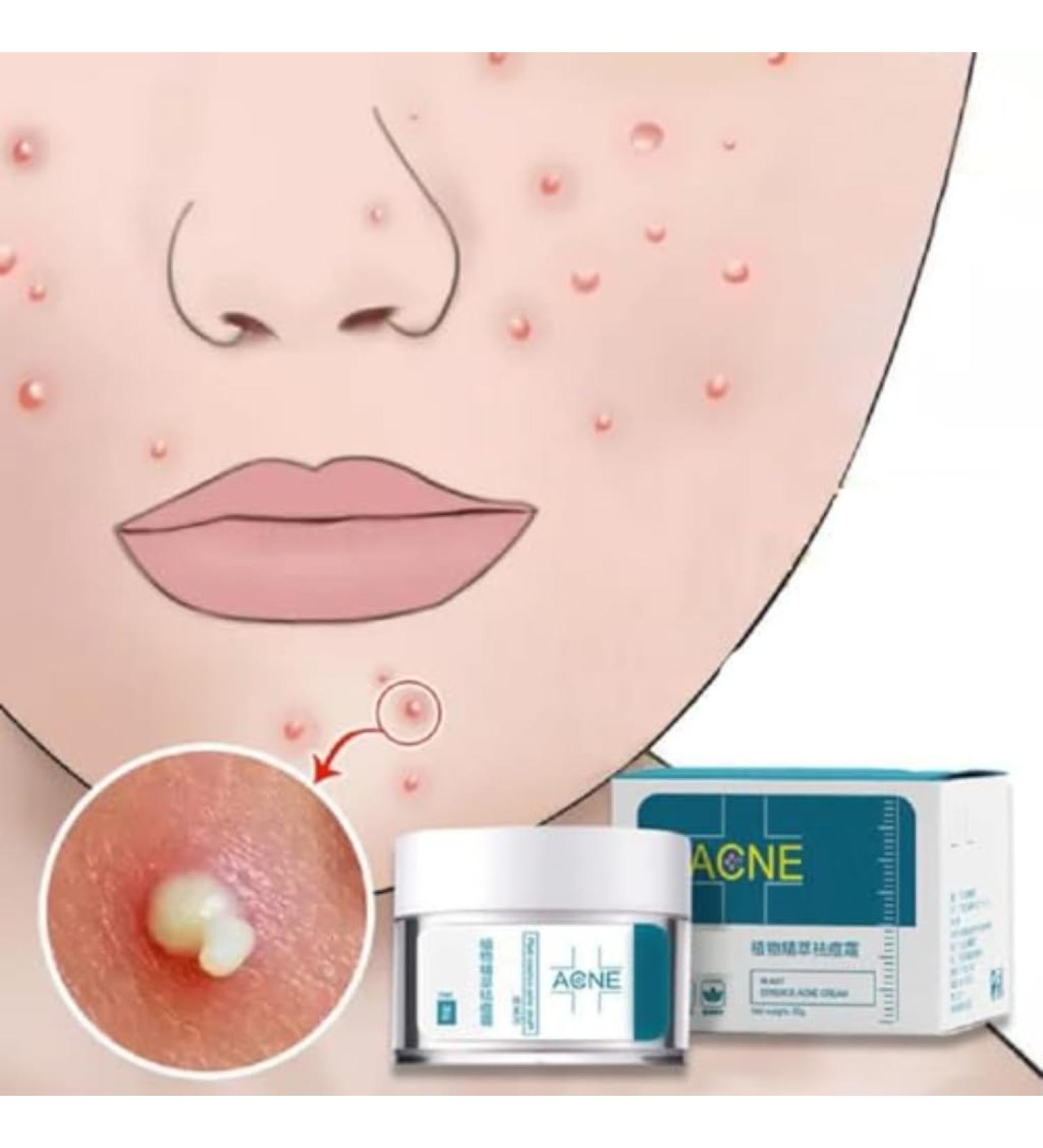 Crema Para El Acne ELIMINA Barros Espinillas Y Manchas RECUPERA Tu Piel LINDA - Buy Online on GoSupps.com