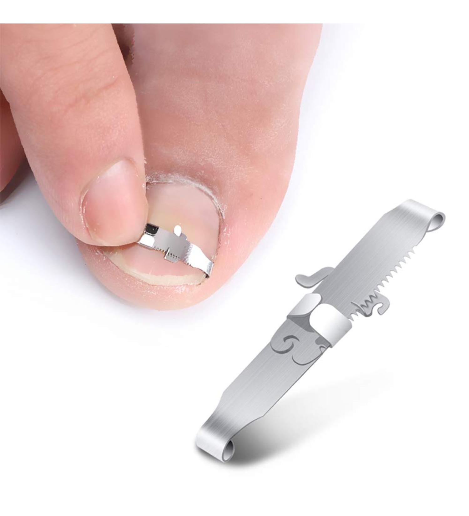 Bezox 2PC Ingrown Toenail Tools - Nail Correction Buckle & Lifter Surgical Stainless Steel for Paronychia Treatment (Size 37-40) | International Shipping Available - Buy Online on GoSupps.com