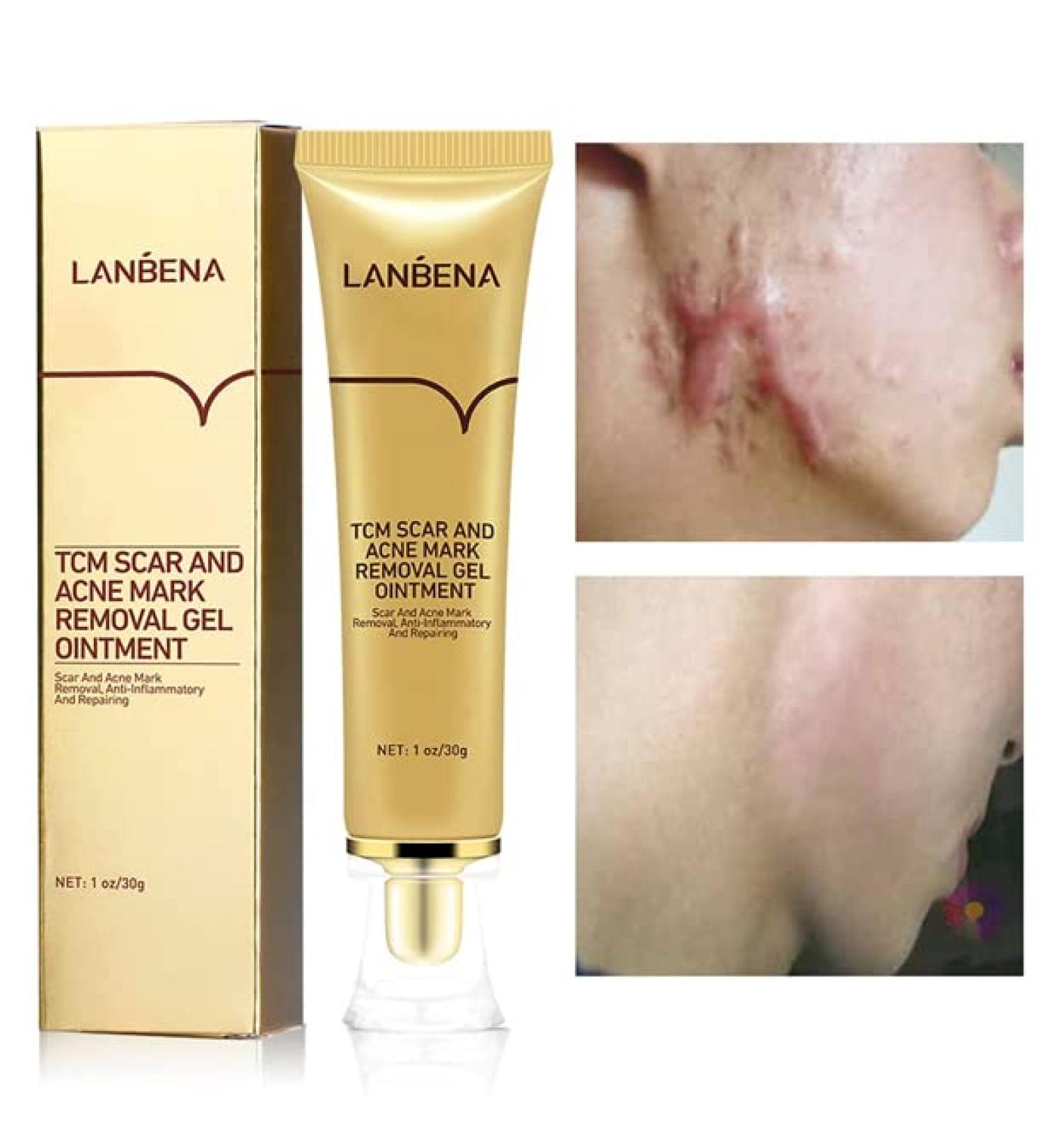AKARY Acne Scar Removal Cream - Herbal Fade Marks Repair | Stretch Marks Face Gel | Shrink Pores & Repair Old/New Scars - Skin Care - Buy Online on GoSupps.com