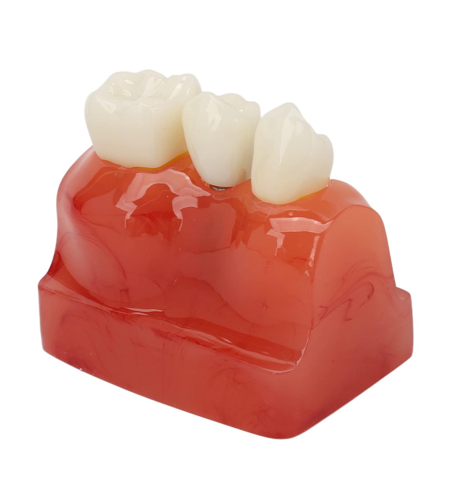 Dental Implant Model - 4x Enlargement Crown Bridge Demo Model for Recovery Effect Comparison | International Shipping Available - Buy Online on GoSupps.com
