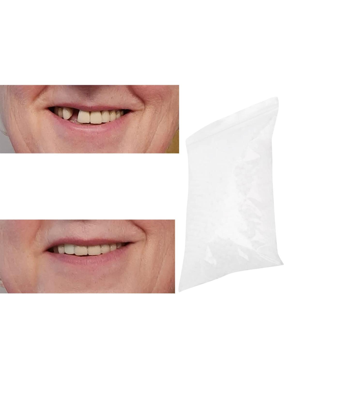 Clip in Veneer Teeth | Temporary Tooth Repair Beads & Dental Cement (100g) for Missing & Broken Teeth - International Shipping - Buy Online on GoSupps.com