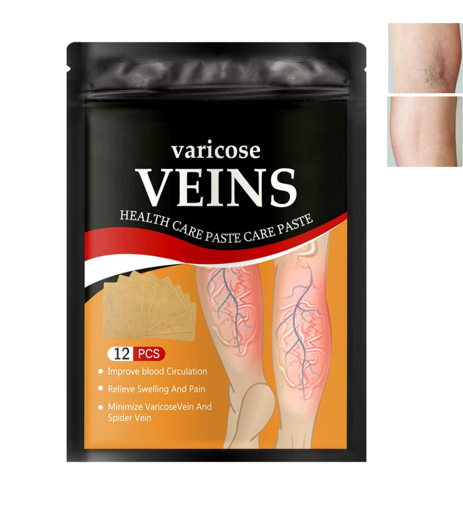 Varicose Vein Relief Patches - Herbal Plasters for Spider Veins & Leg Treatment | International Shipping - Buy Online on GoSupps.com