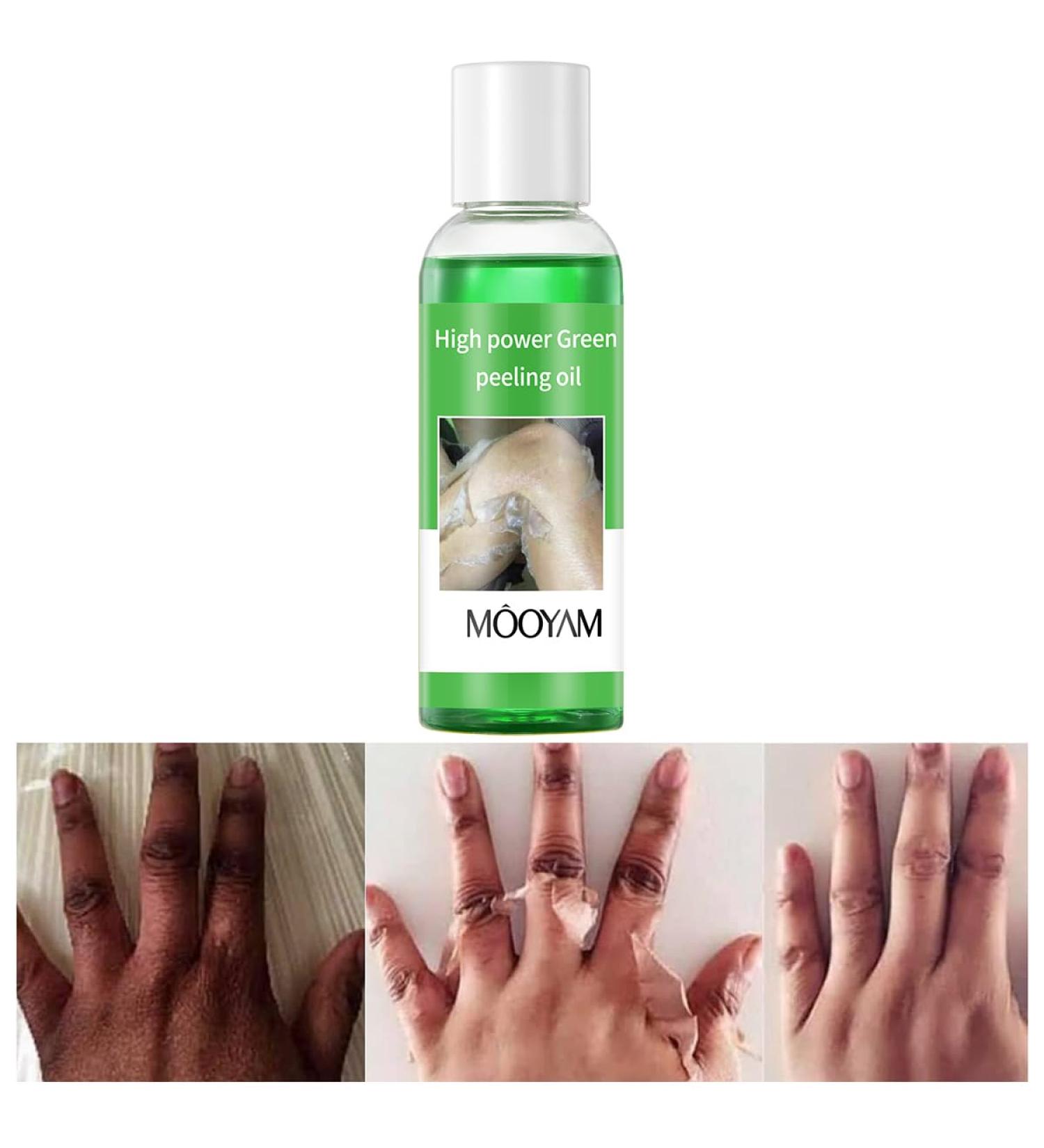 Peeling Oil for Dark Skin - Green Facial & Body Exfoliating Solution with Hyaluronate | Chemical Peel for Dark Spots - 3.66 OZ - Buy Online on GoSupps.com