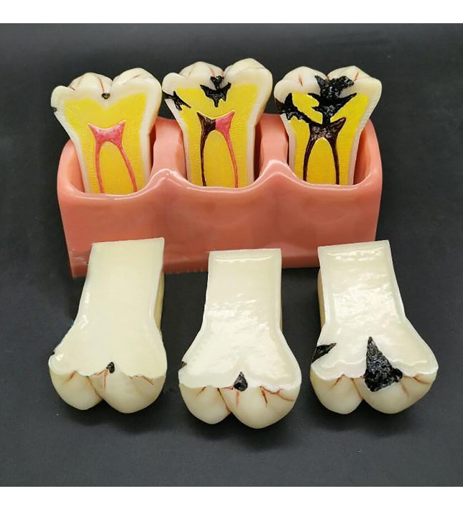Buy Samnuerly 4-Fold Dental Teeth Caries Model - Removable Tooth Pathology & Evolutionary Display for Dental Training | International Shipping Available - Buy Online on GoSupps.com