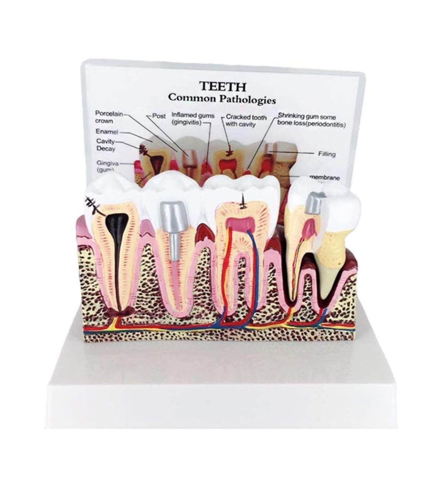 PSVOD 4x4 Anatomy Models for Dental Diseases | Educational Tools for Oral Care & Teaching - Buy Online on GoSupps.com