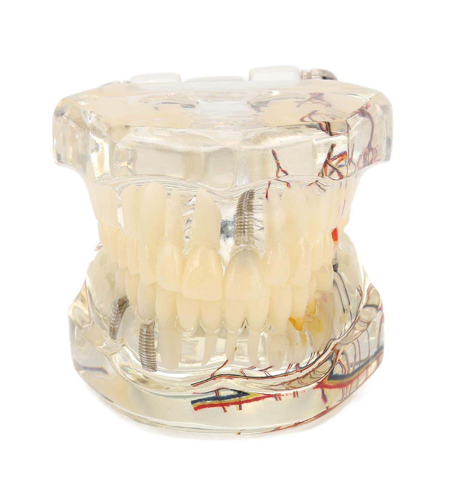 Buy Verdant Touch Pathological Implant Model - Transparent Dental Implant for Teaching & Demonstration - International Shipping Available - Buy Online on GoSupps.com