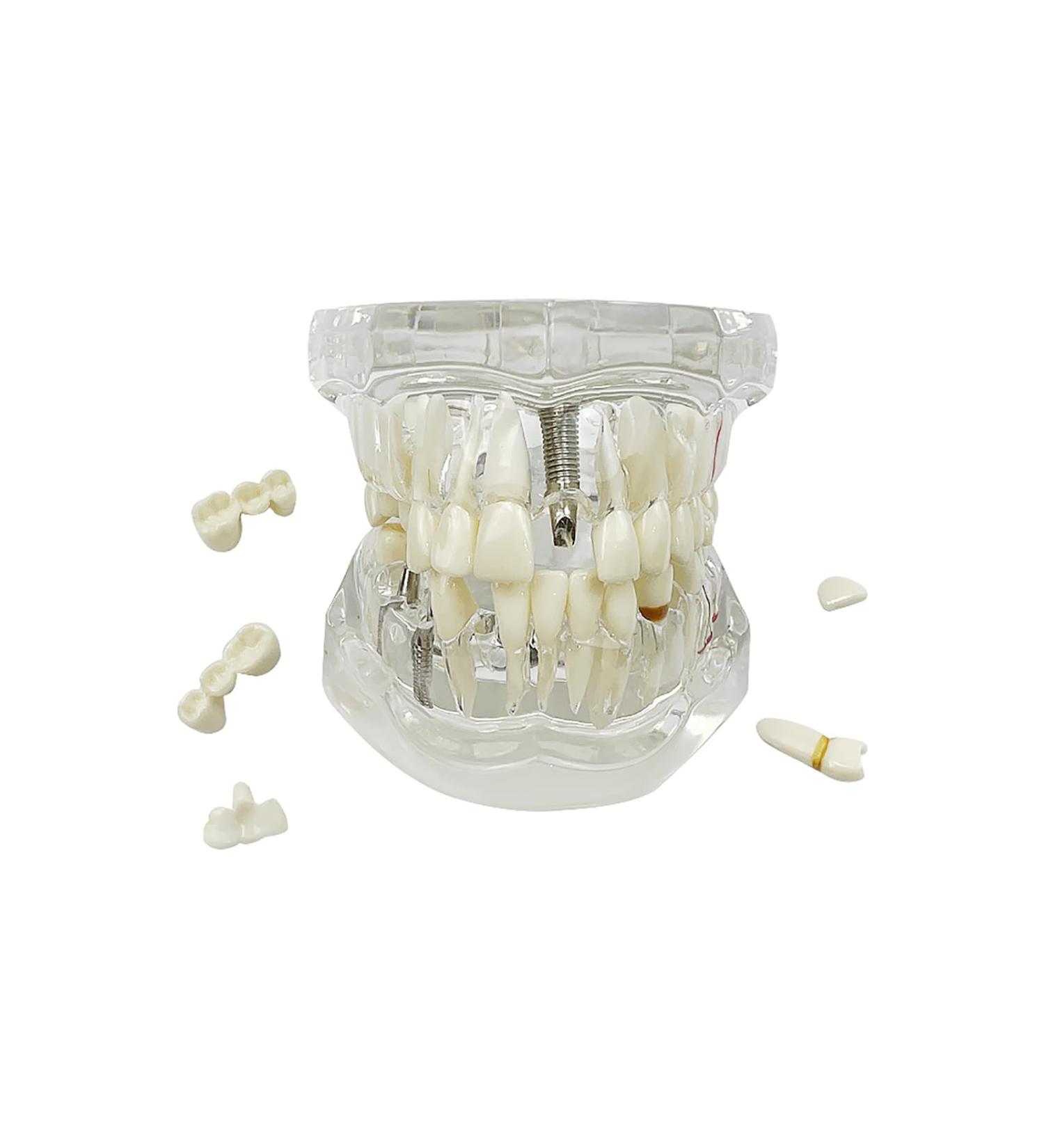 Buy Youya Transparent Dental Tooth Model for Dentists | Removable Pathological Teaching Model | International Shipping Available - Buy Online on GoSupps.com