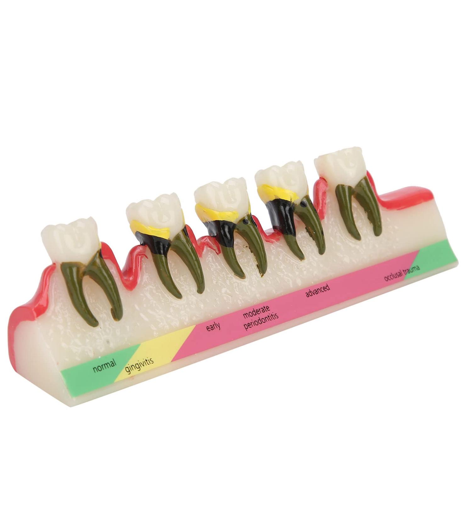 Dental Periodontitis Model | Periodontal Development Study Tool for Dental Research & Learning - Buy Online on GoSupps.com