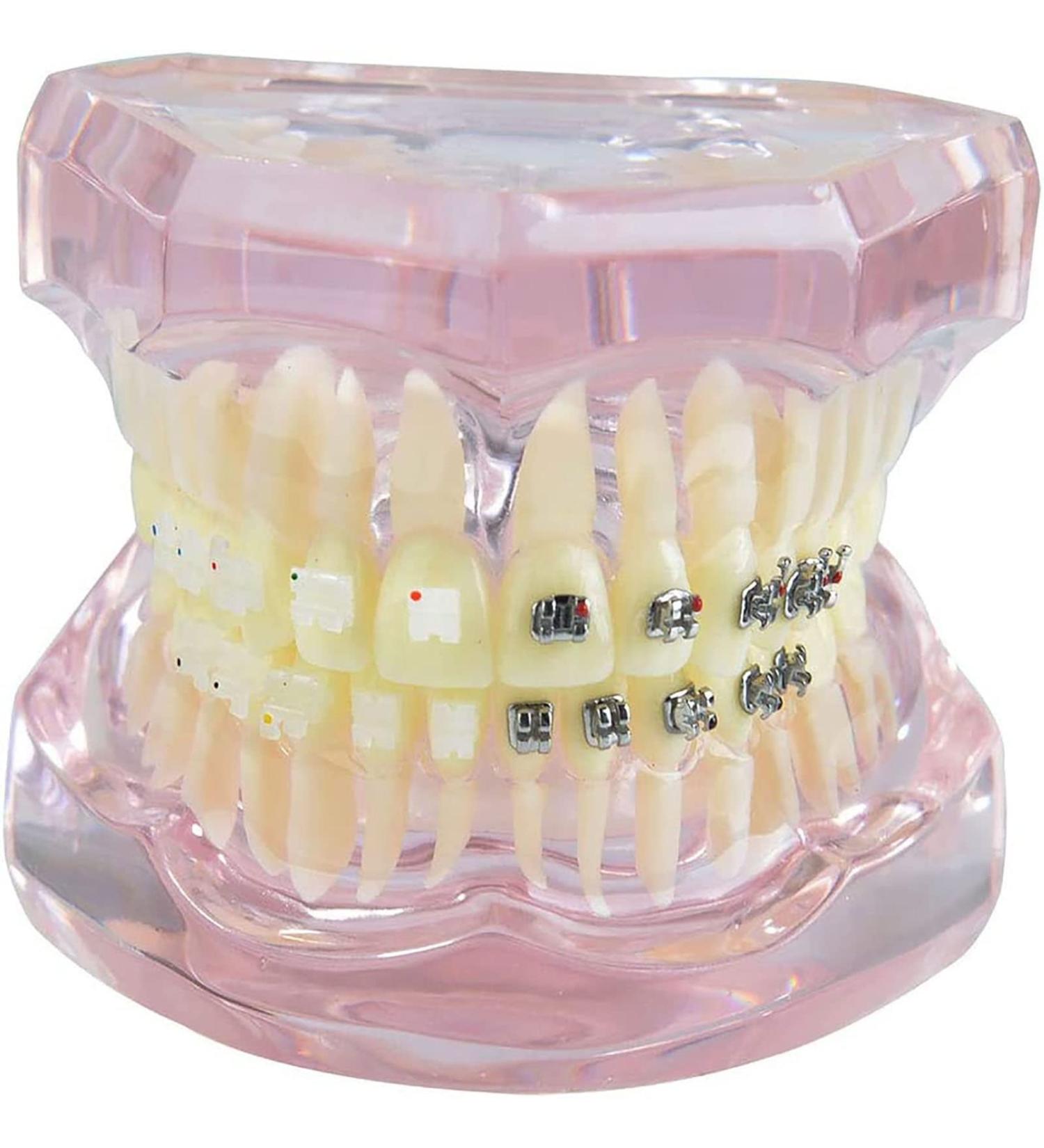 Buy Luceae Dental Orthodontic Demonstration Model | Self-Ligating Retainer Treatment for Dentures - International Shipping Available - Buy Online on GoSupps.com