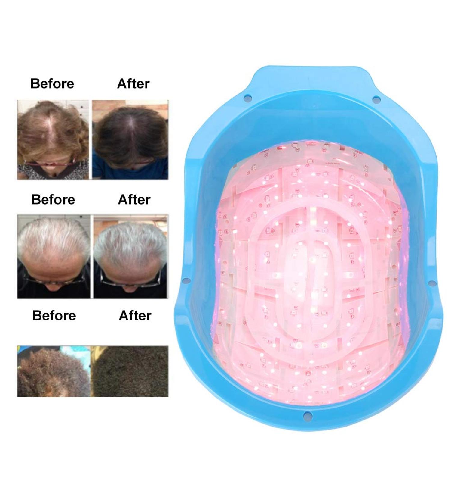 Laser Therapy Hair Growth Helmet | Anti-Hair Loss Device for Men & Women | Promote Hair Growth & Strength | White Laser Cap - Buy Online on GoSupps.com