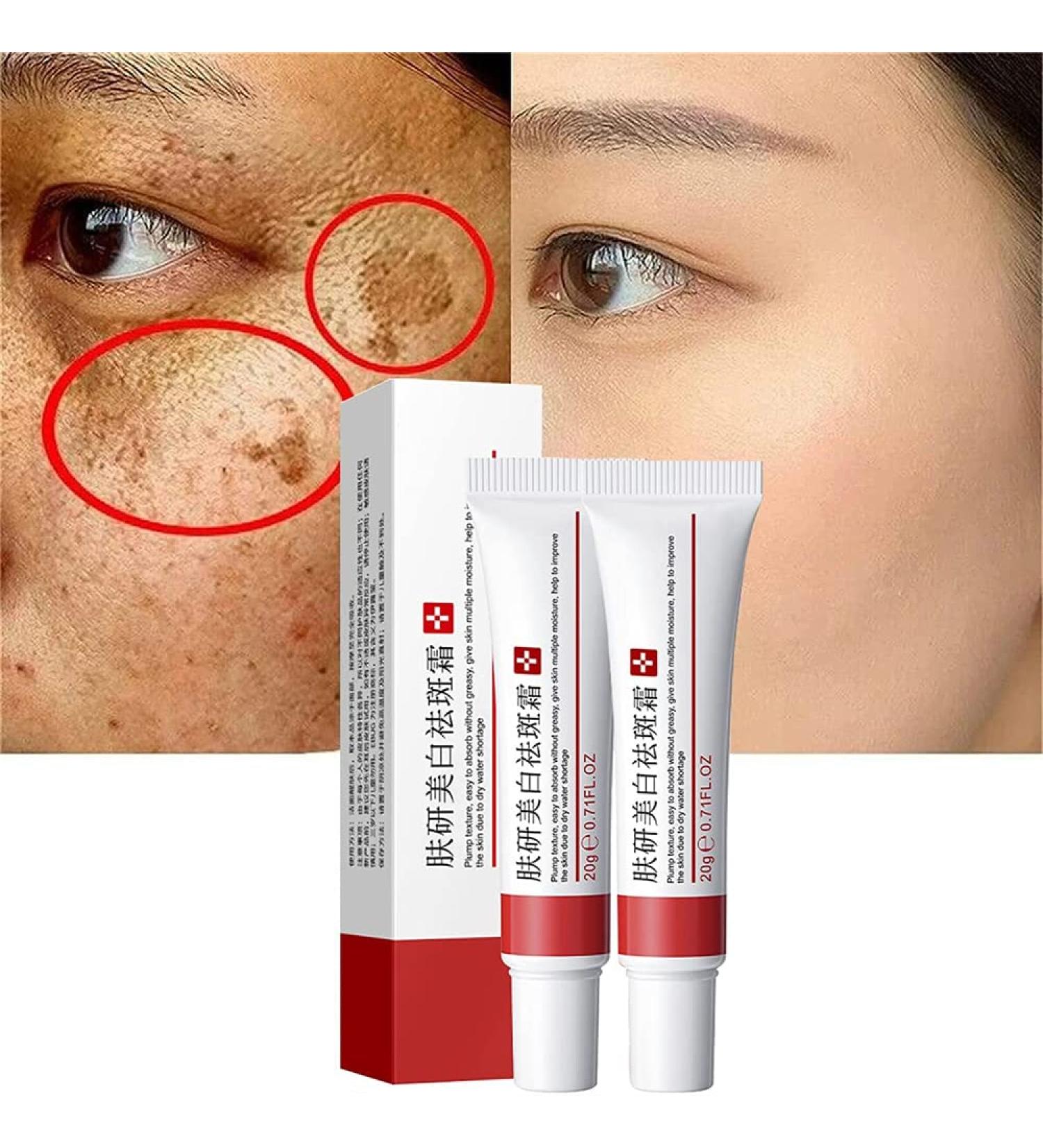 2Pcs Whitening Freckle Cream Acne Scar Removal Treatment Cream Pigmentation Removal Cream for Face Effectively Removes Facial Melasma Dark Spots Blemishes - Buy Online on GoSupps.com