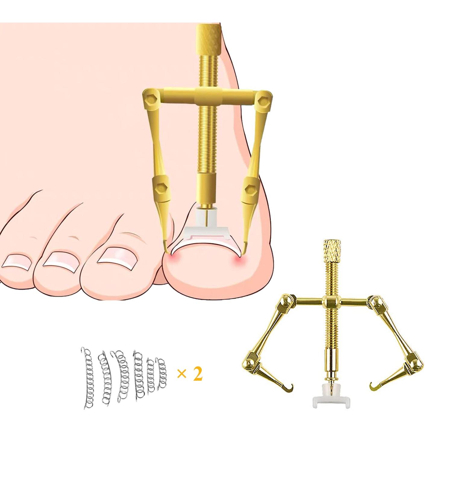 Ingrown Toenail Treatment Kit - Stainless Steel Corrector for Curved Toenails | Includes 12 Braces - Buy Online on GoSupps.com