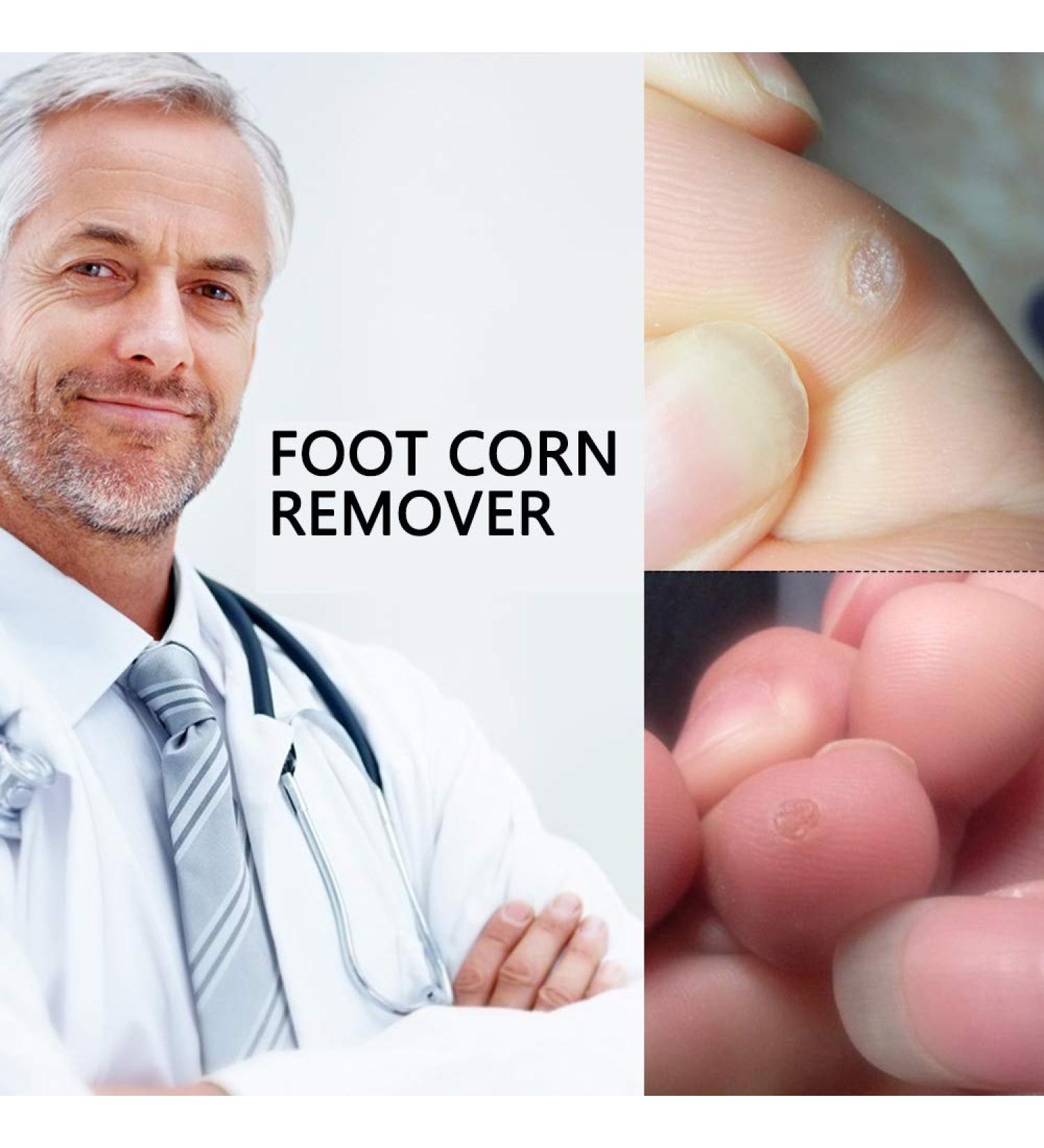 Zhangl Massage Foot Corn Remover - 20 Boxes of Effortless Feet Care & Massage for Healthy Feet - Buy Online on GoSupps.com