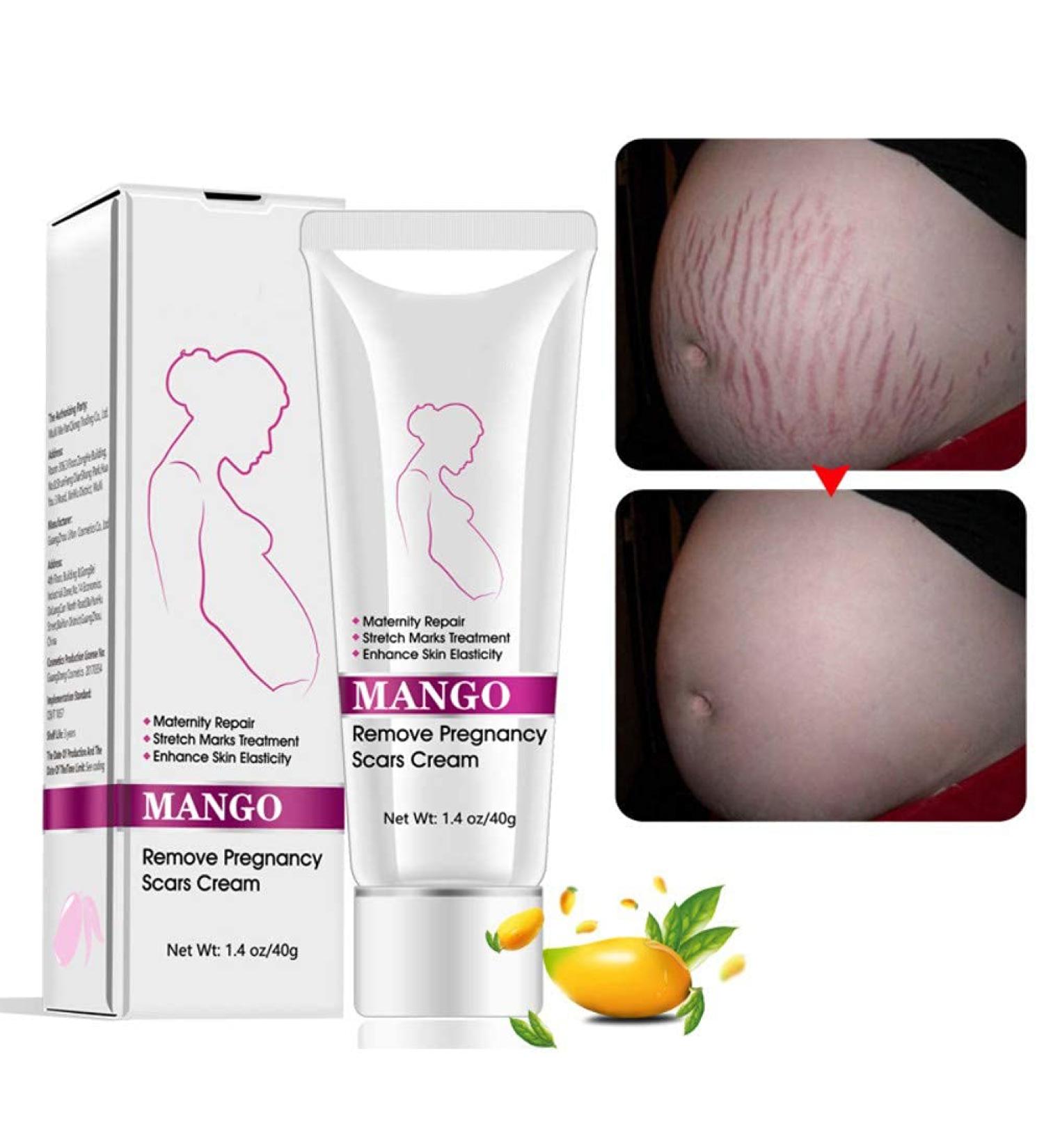 Best Stretch Mark Cream for Pregnancy & Postpartum - Repair & Remove Scars - Buy Online on GoSupps.com