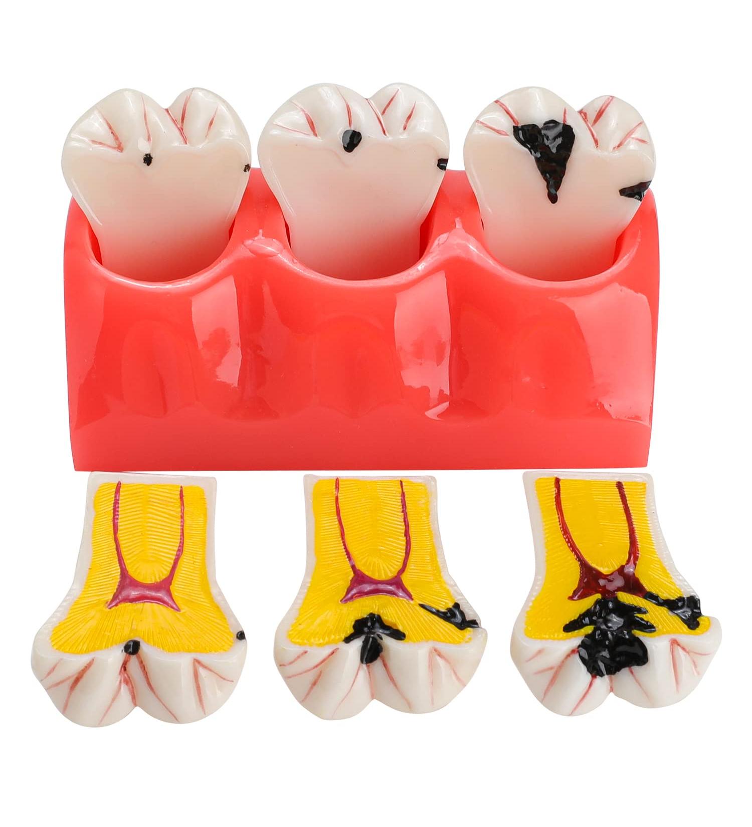 Buy Dental Caries Teeth Model - 4X Removable Tooth Decay & Pathology Display | International Shipping - Buy Online on GoSupps.com
