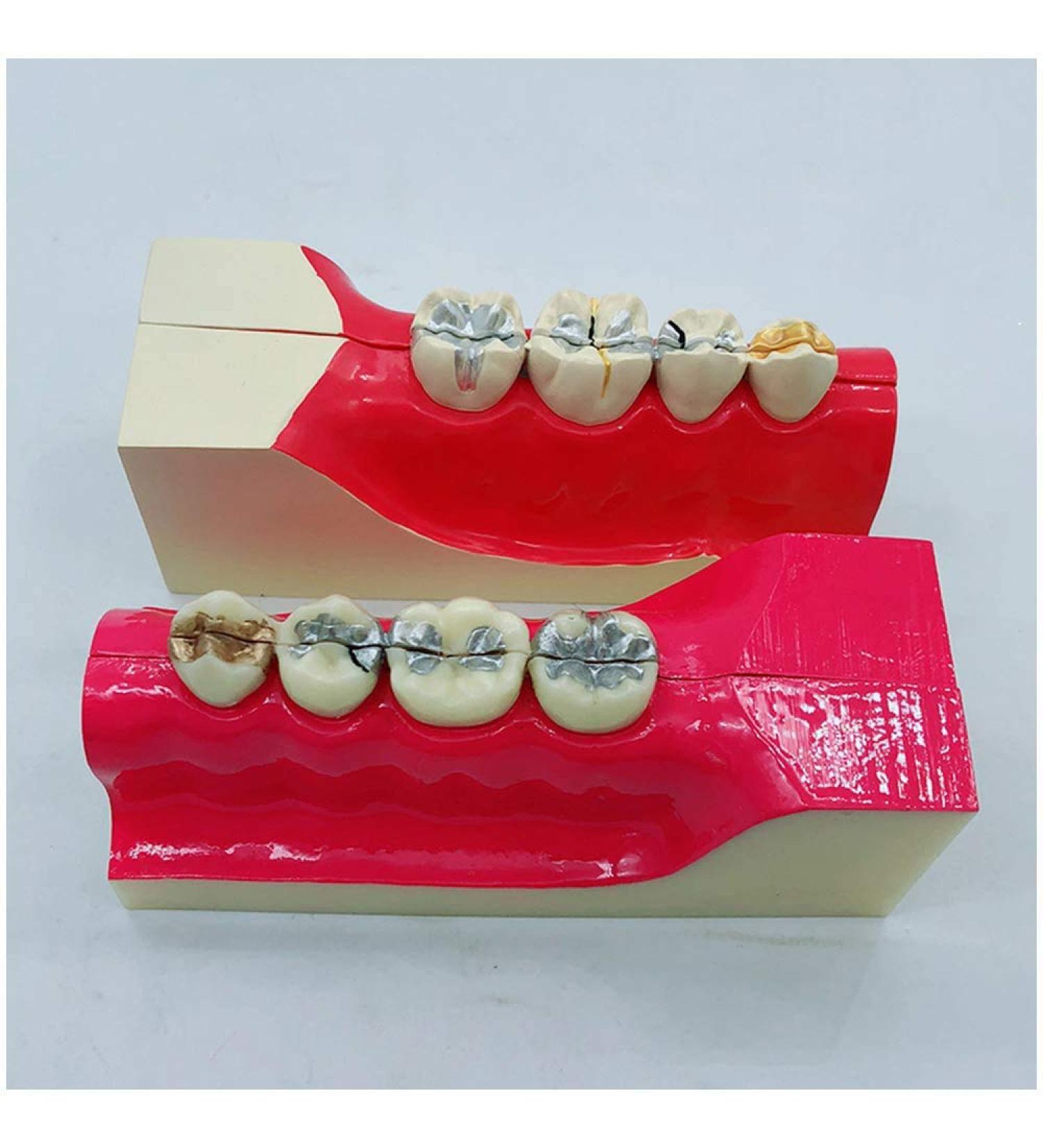 Croix Dentaire Molar Section | Oral Simulation Teeth Model for Dental Study | Educational Dental Model with Nerve Line for Tissue Dissection - Buy Online on GoSupps.com