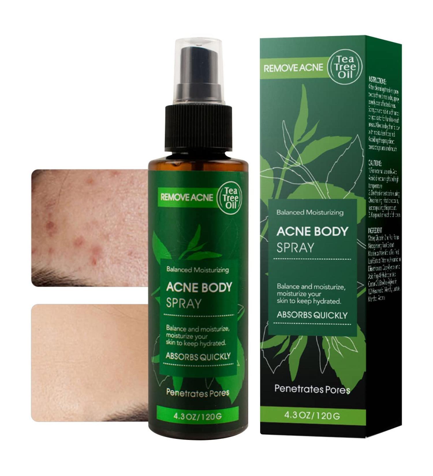 Best Acne Treatment Spray with Organic Tea Tree Oil - Clear Acne on Face Body & Back | 4.3 OZ Skin Care Solution - Buy Online on GoSupps.com