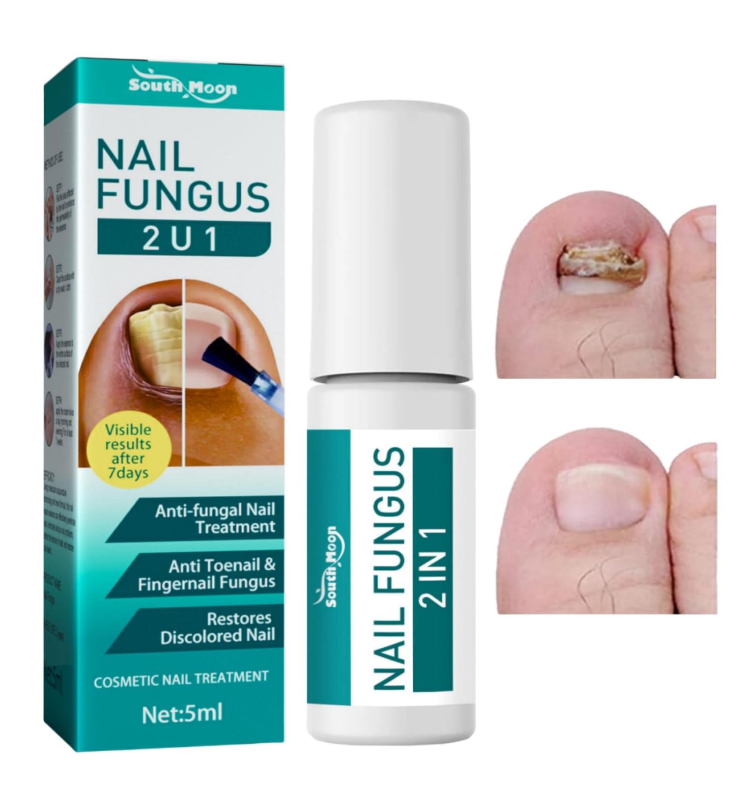 2 IN 1 Nail Fungus Treatment Oil - Fast Relief for Toenail Paronychia & Fungal Infections - Buy Online on GoSupps.com