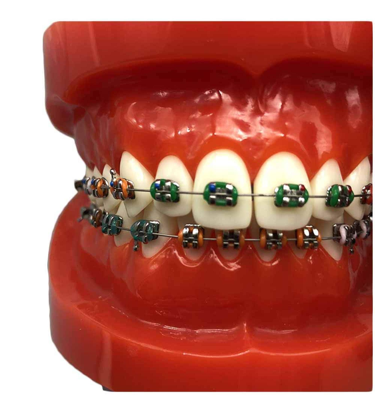 Orthodontic Teeth Model Dental Typodont with Metal Brackets & Ligature Ties - Red | International Shipping Available - Buy Online on GoSupps.com