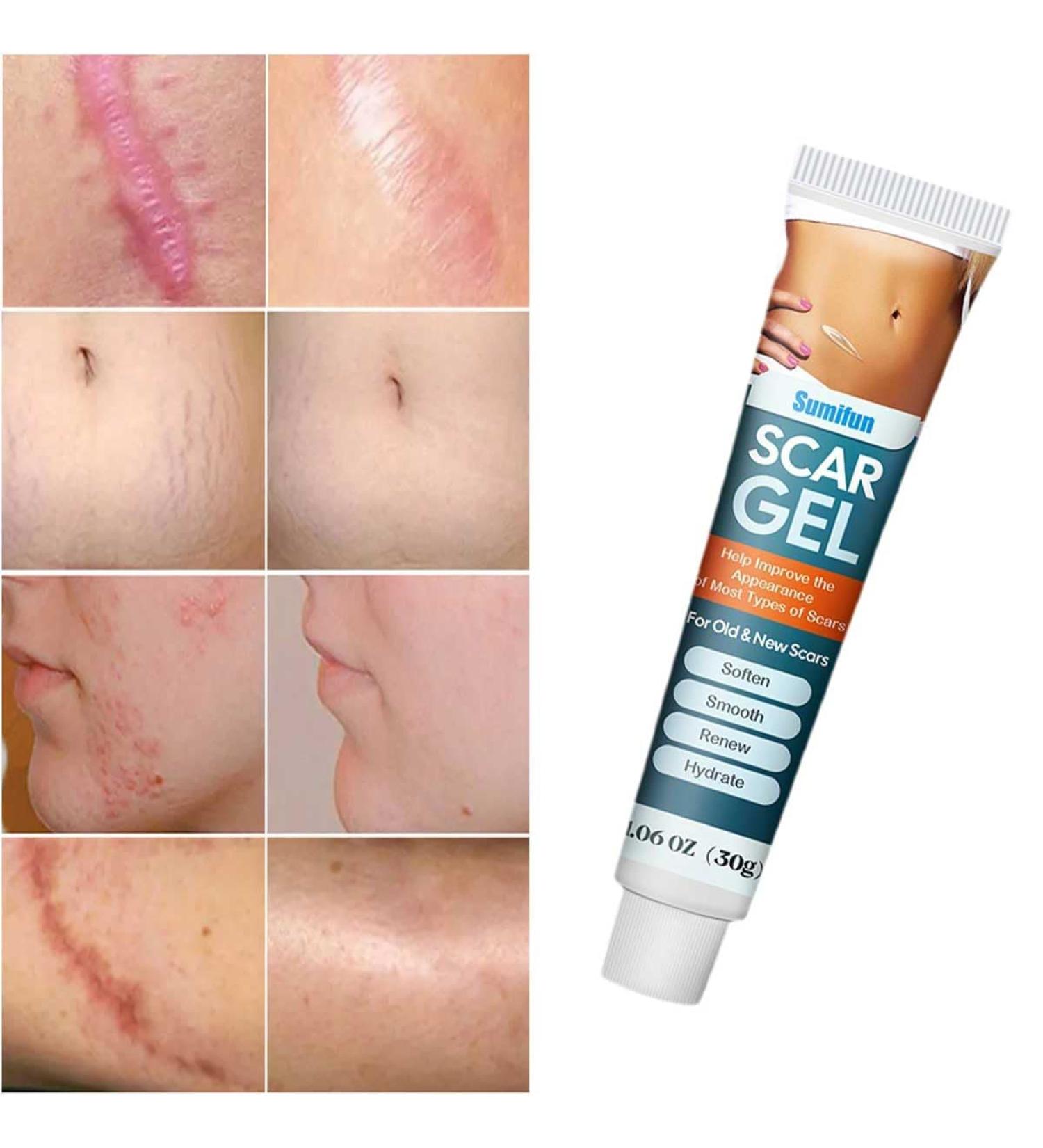 Advanced Scar Cream Gel - Effective Scar Removal for Surgical Scars Burns Acne C-Sections & More | Suitable for All Skin Types - 1.06 Oz - Buy Online on GoSupps.com