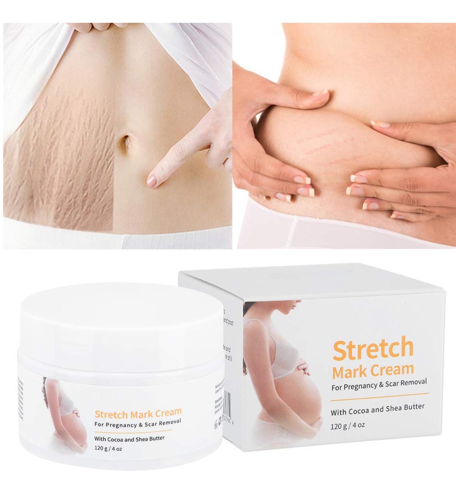 Stretch Stripes Cream 120g | Remove Stretch Marks Pregnancy Scars & Acne | Maternity Repair Treatment - Buy Online on GoSupps.com
