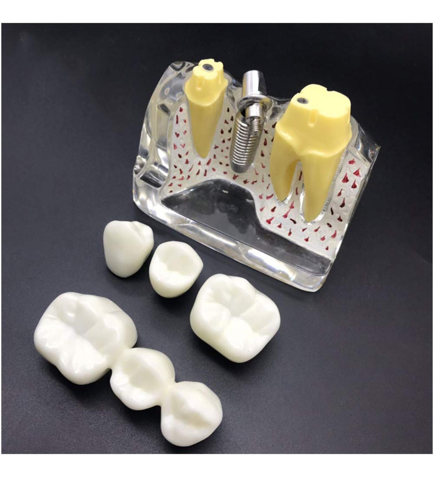 4x Enlarged Teeth Model for Dental Education | Implant & Crown Simulation | Ideal for Teaching & Demonstration - Buy Online on GoSupps.com
