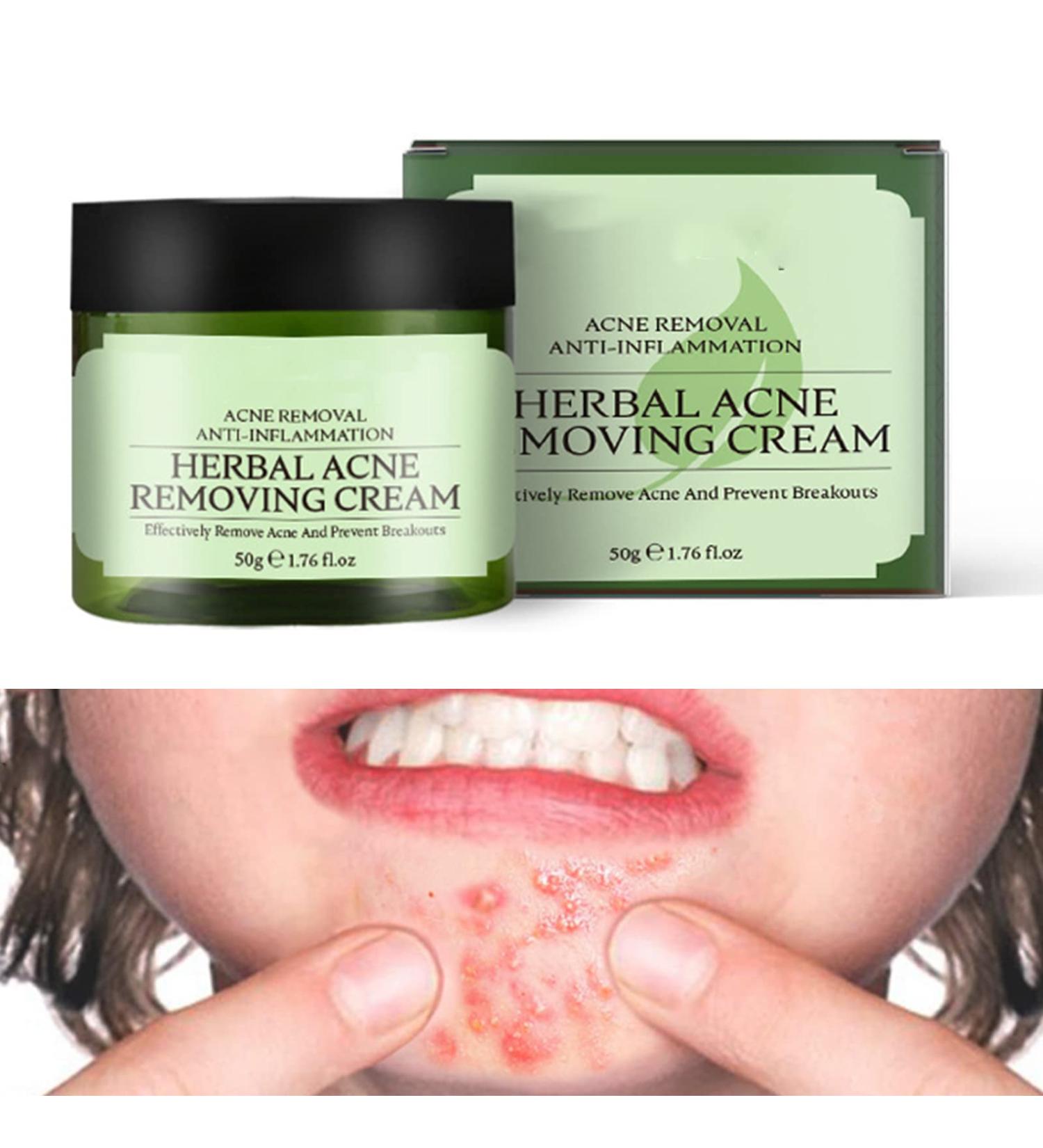 Acne Cream Moisturiser Face Cream Spot Cream Mens Moisturiser Tea Tree Cream Spot Cream For Acne Cream Moisturiser for Women Men Teenagers Dilute Face Prone Spot Marks Balance Facial Oil Cream - Buy Online on GoSupps.com