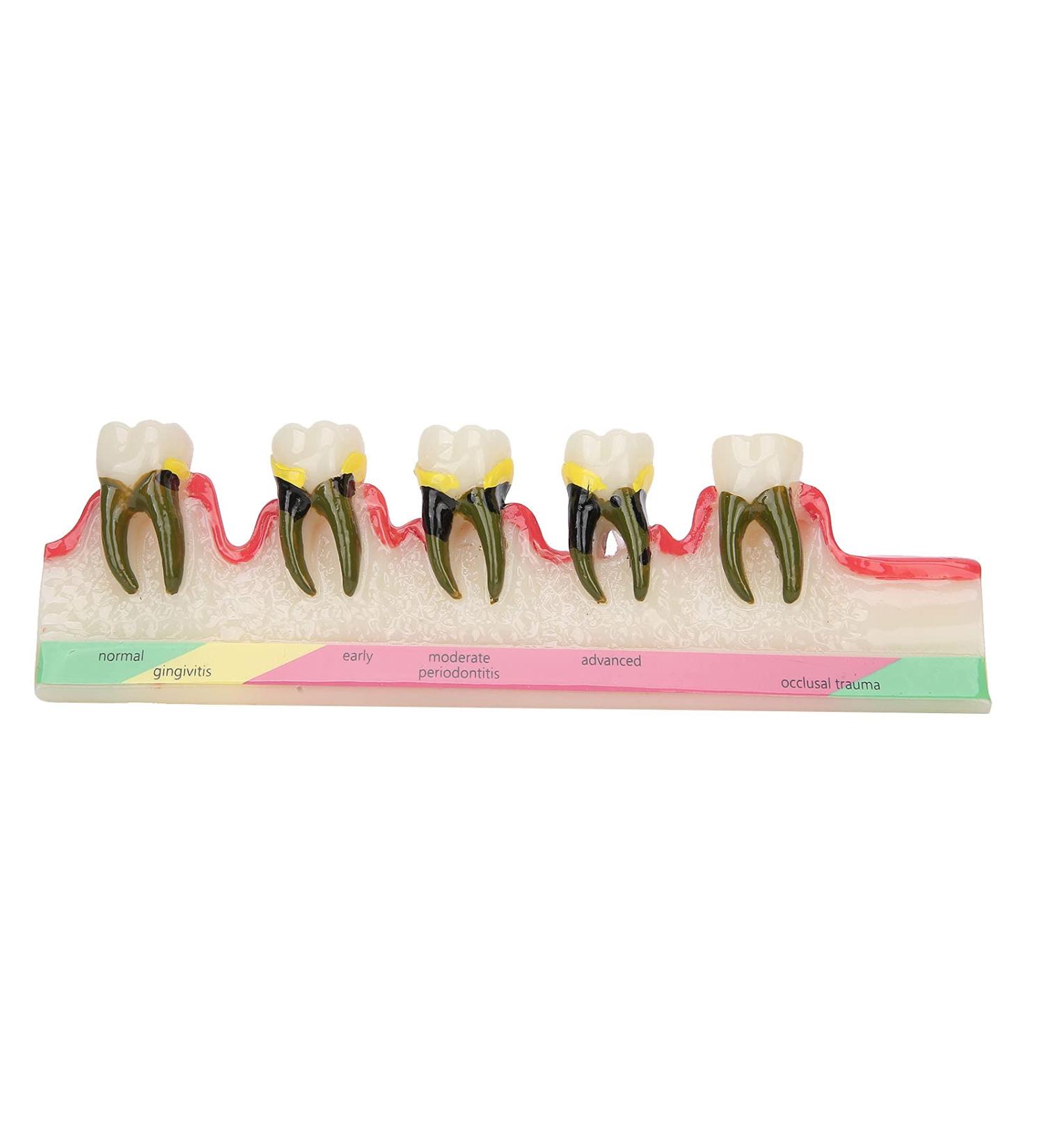 Dental Periodontal Disease Model Tooth Disease Study Teaching Model for Dental School - Buy Online on GoSupps.com