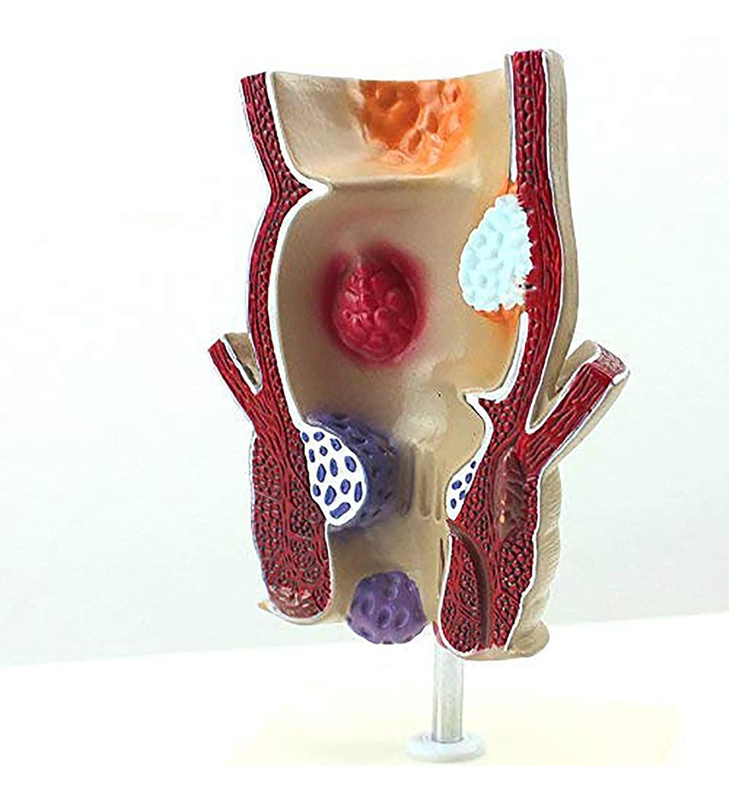 ZCBYBT Hemorrhoid Injury Model Human Rectal Pathology Model Internal and External Hemorrhoids Model Anus Model Suitable for Educational Use - Buy Online on GoSupps.com