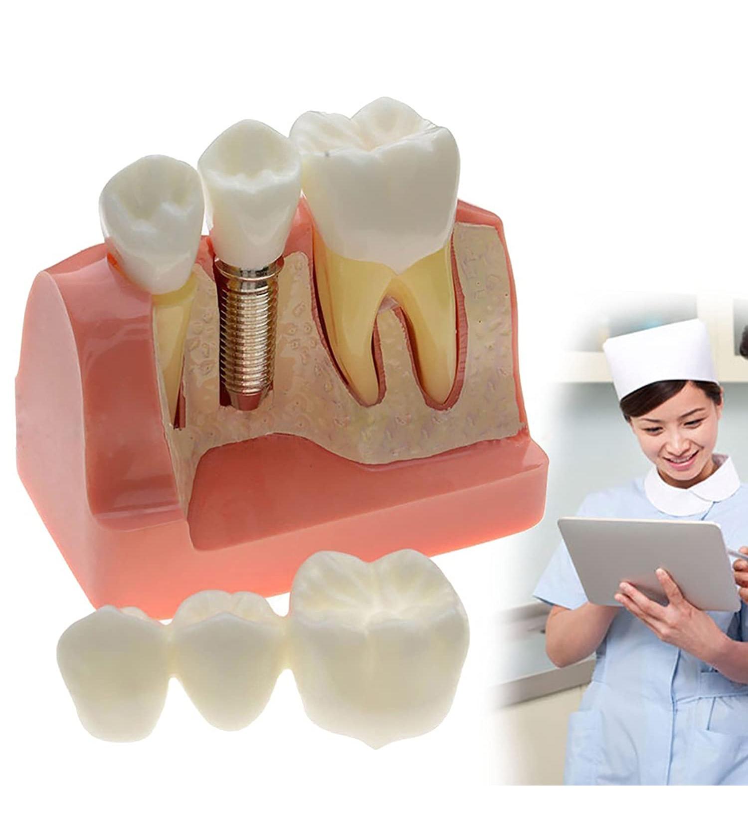 Samnuerly 4-Fold Dental Implant Crown Bridge Model - Compare Results for Patient Communication | International Shipping - Buy Online on GoSupps.com