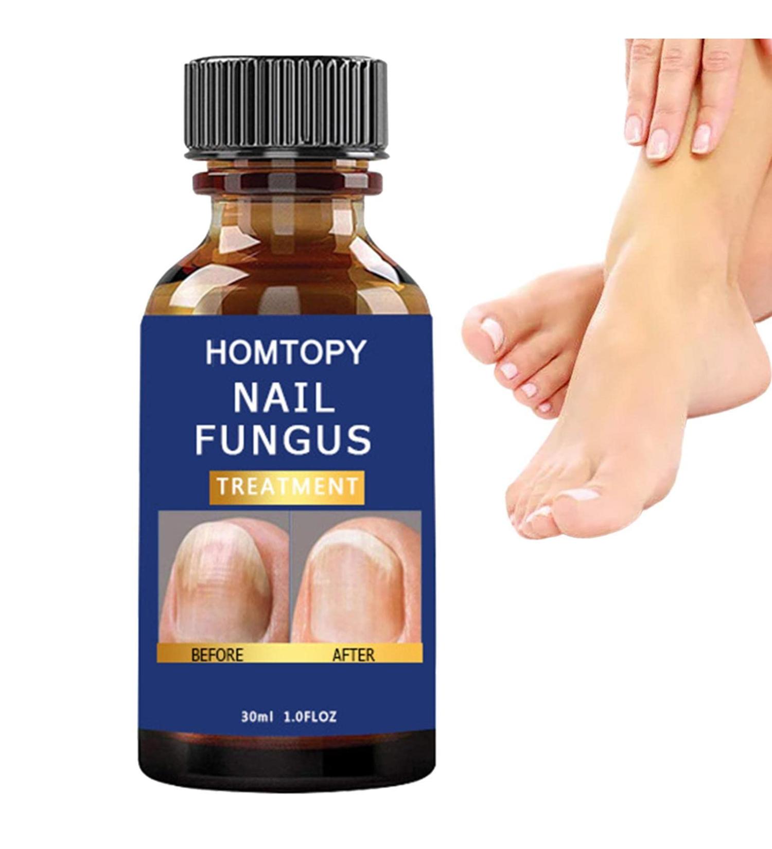 Durcisseur et fortifiant pour Ongles | Mycoses Solution Extra Forte pour Les Ongles - Patchs pour Ongles Anti-fongiques pour Le renouvellement des Ongles Force maximale pour Les - Buy Online on GoSupps.com