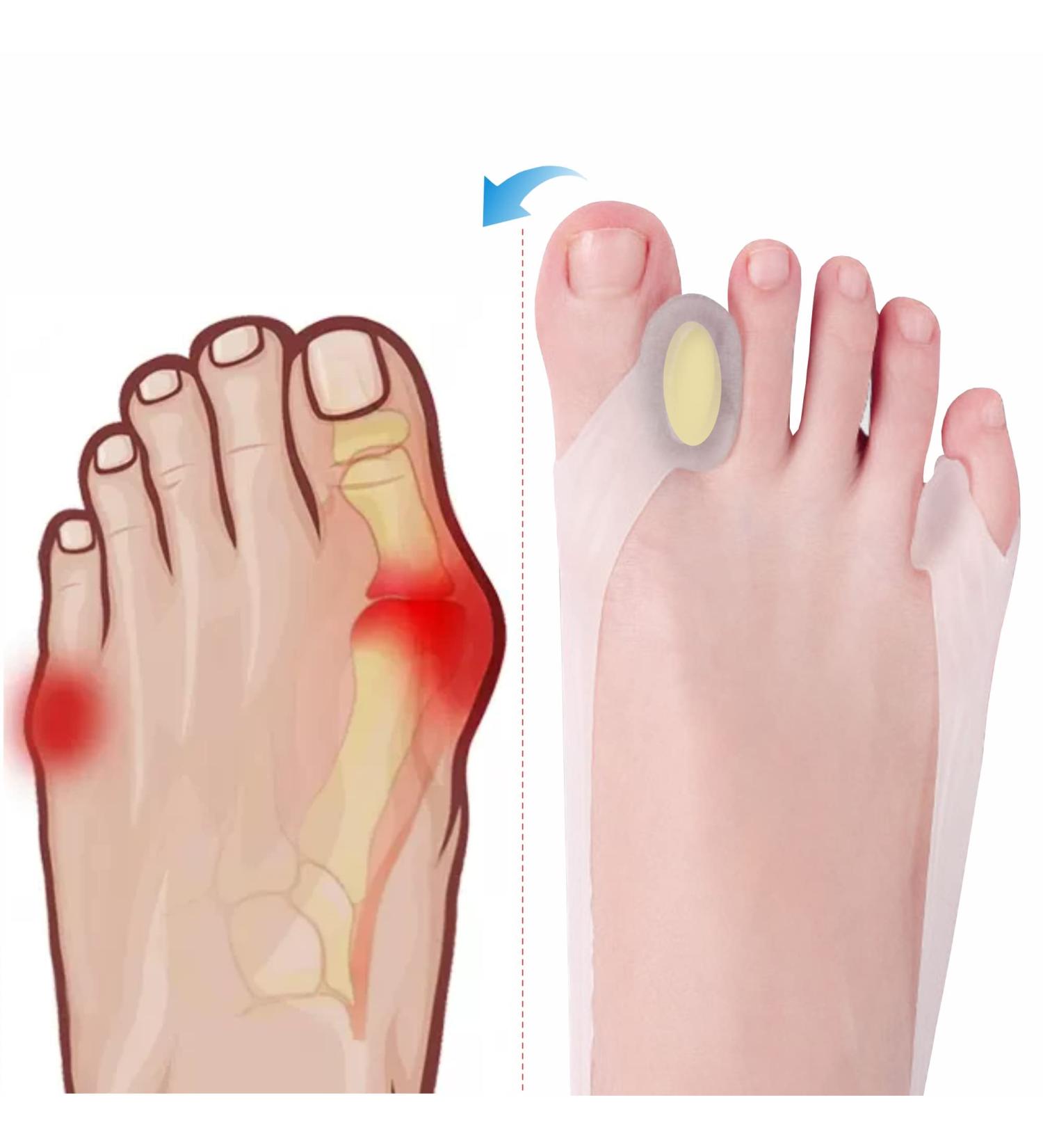 Adjustable Toe Separator & Corrector for Women - Large Size 8-10 (2PC) - Ashomie New Generation - Buy Online on GoSupps.com