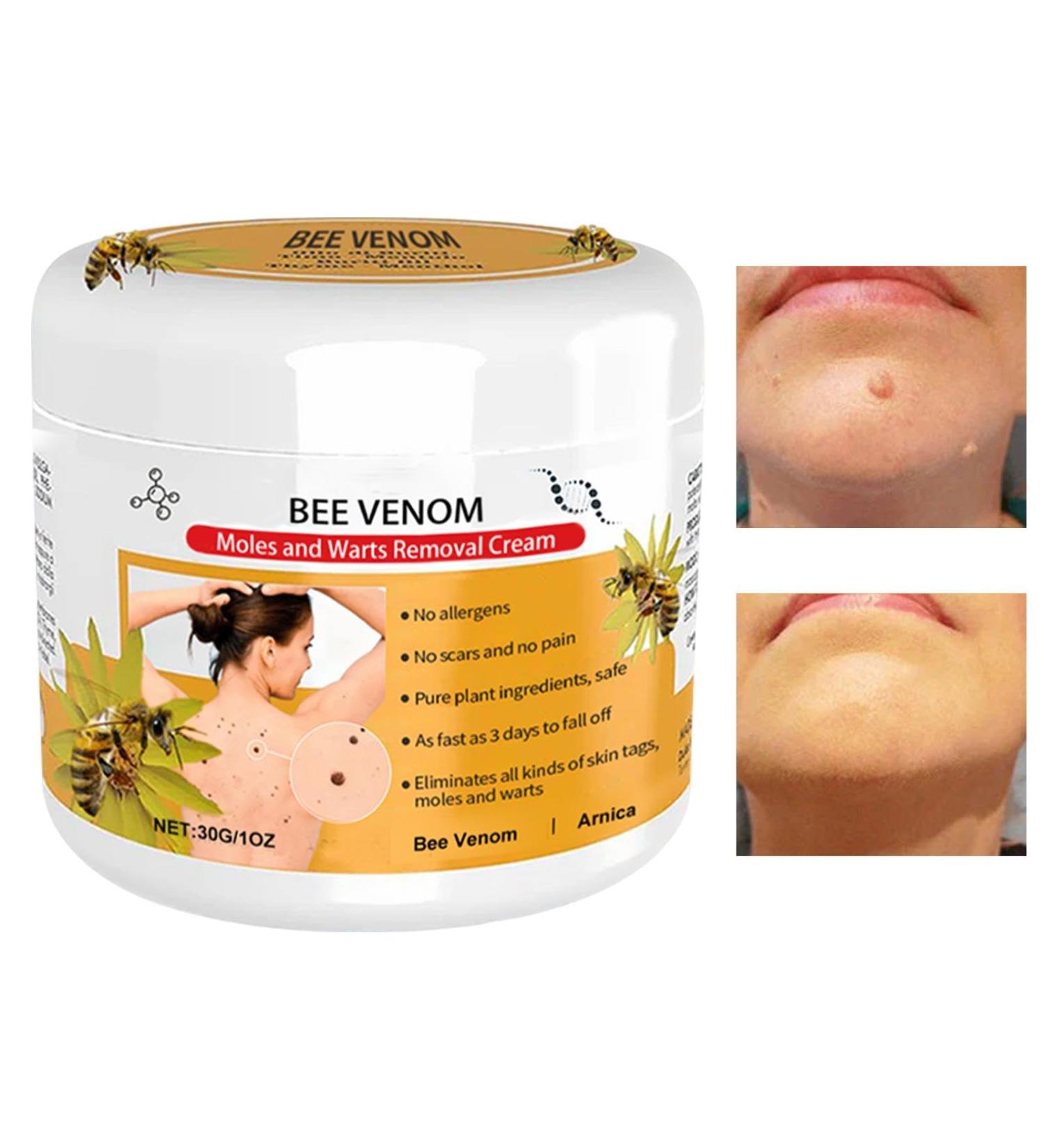 Lenaro Bee Ven-om Wart and Tag Remover Bee Ven-oms Repair Cream Bee Ven-om Hydrating Moisturizing Cream Moisturizes and smoothes skin Remove -ots Cream for All Skin Types - Buy Online on GoSupps.com