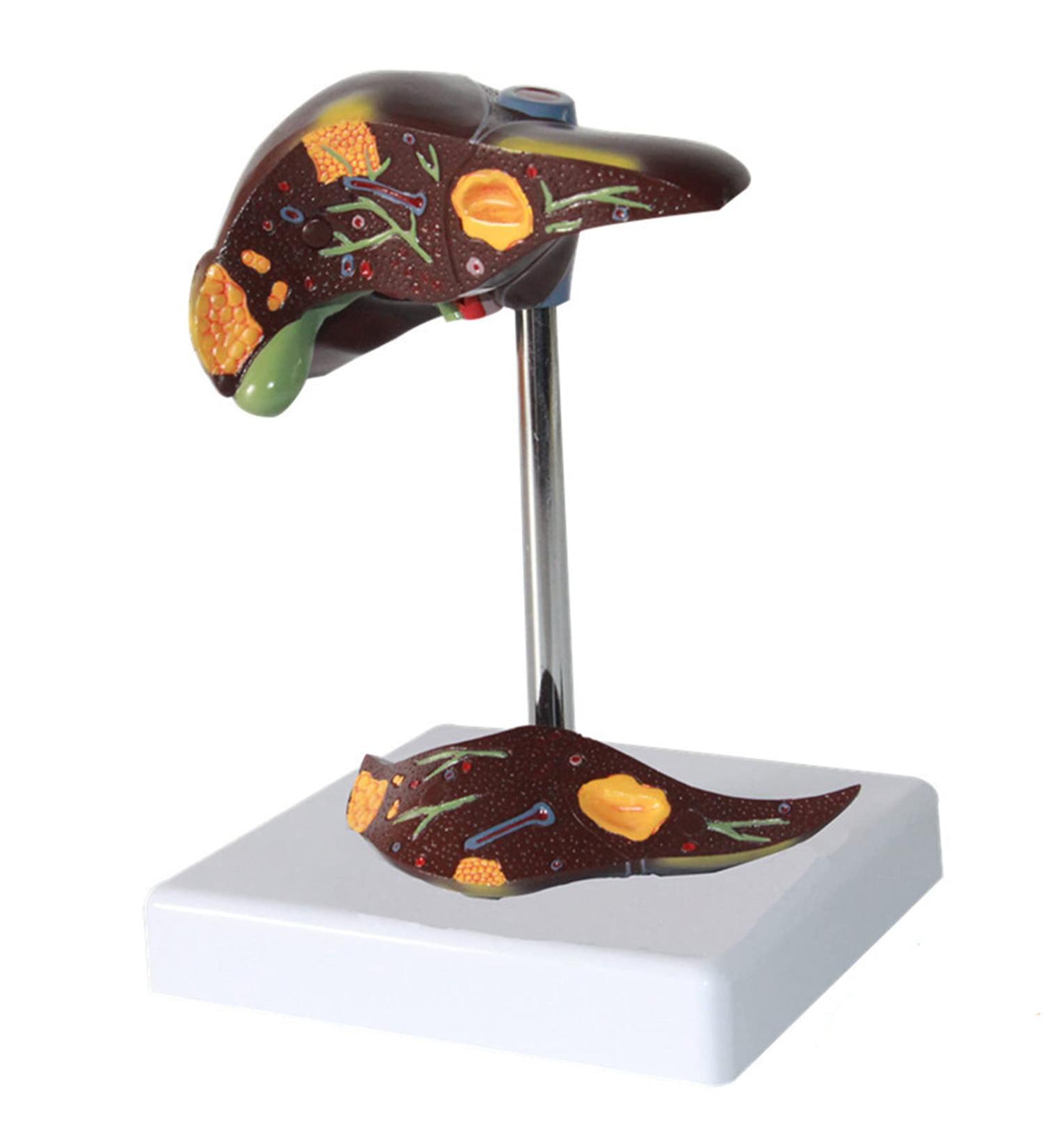 Liver Anatomy Model Human Liver Disease Model Liver Fat/Cirrhosis/Pathological Hepatobiliary Disease Model Medical Education and Training Auxiliary Human Organ Anatomical Model - Buy Online on GoSupps.com
