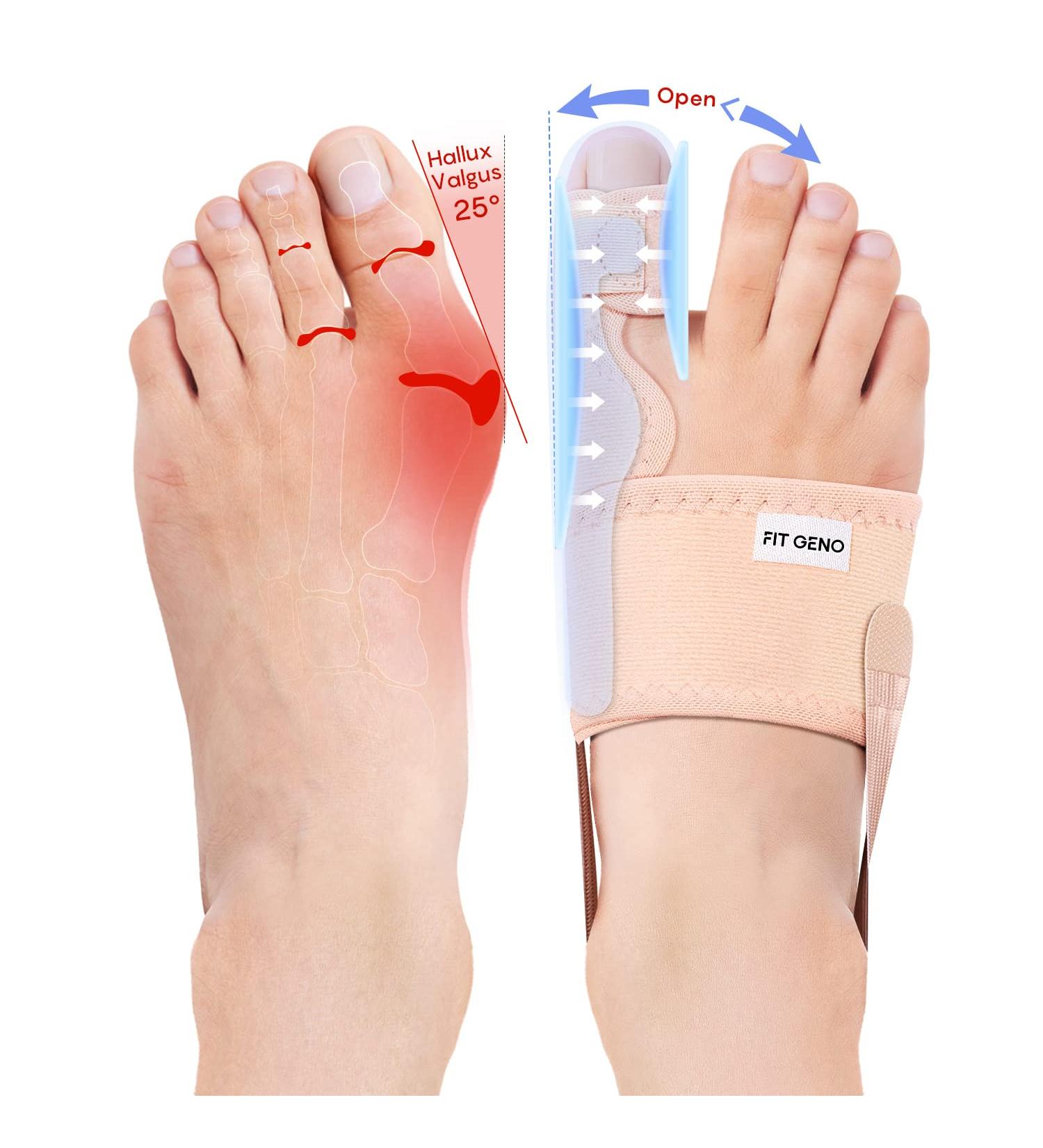 Fit Geno Upgraded Bunion Corrector - 2 Pcs Non-Surgical Toe Corrector for Hallux Valgus Pain Relief - Comfortable & Breathable - Day/Night Support for Men & Women - Buy Online on GoSupps.com