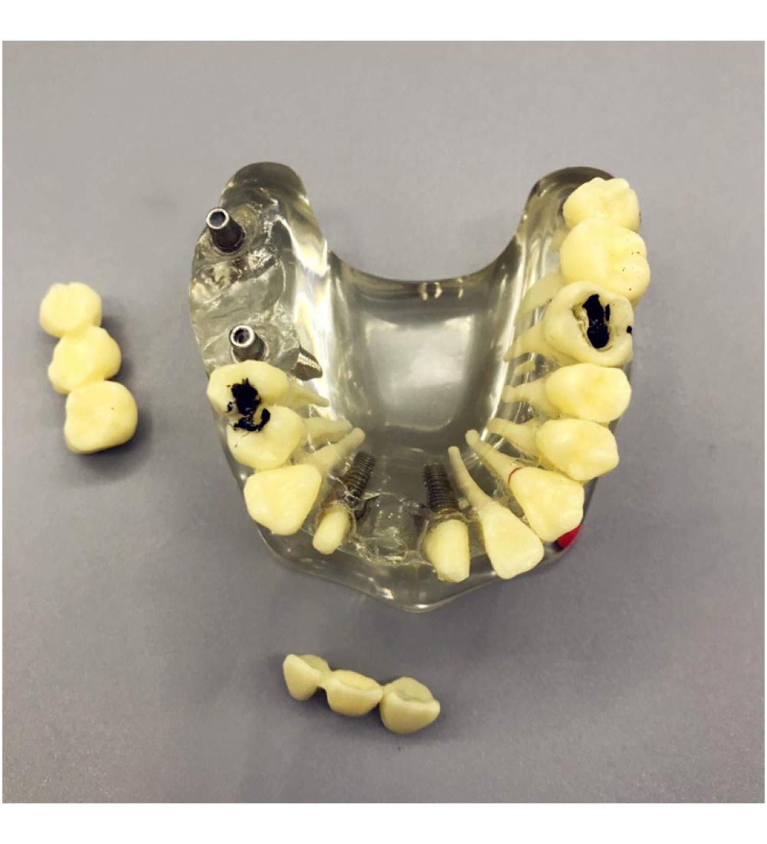 Fhuili Teeth Implant Model - Removable Chewing Gum & Prosthesis - Half-Port Bridge Restoration for Study & Recovery - Buy Online on GoSupps.com