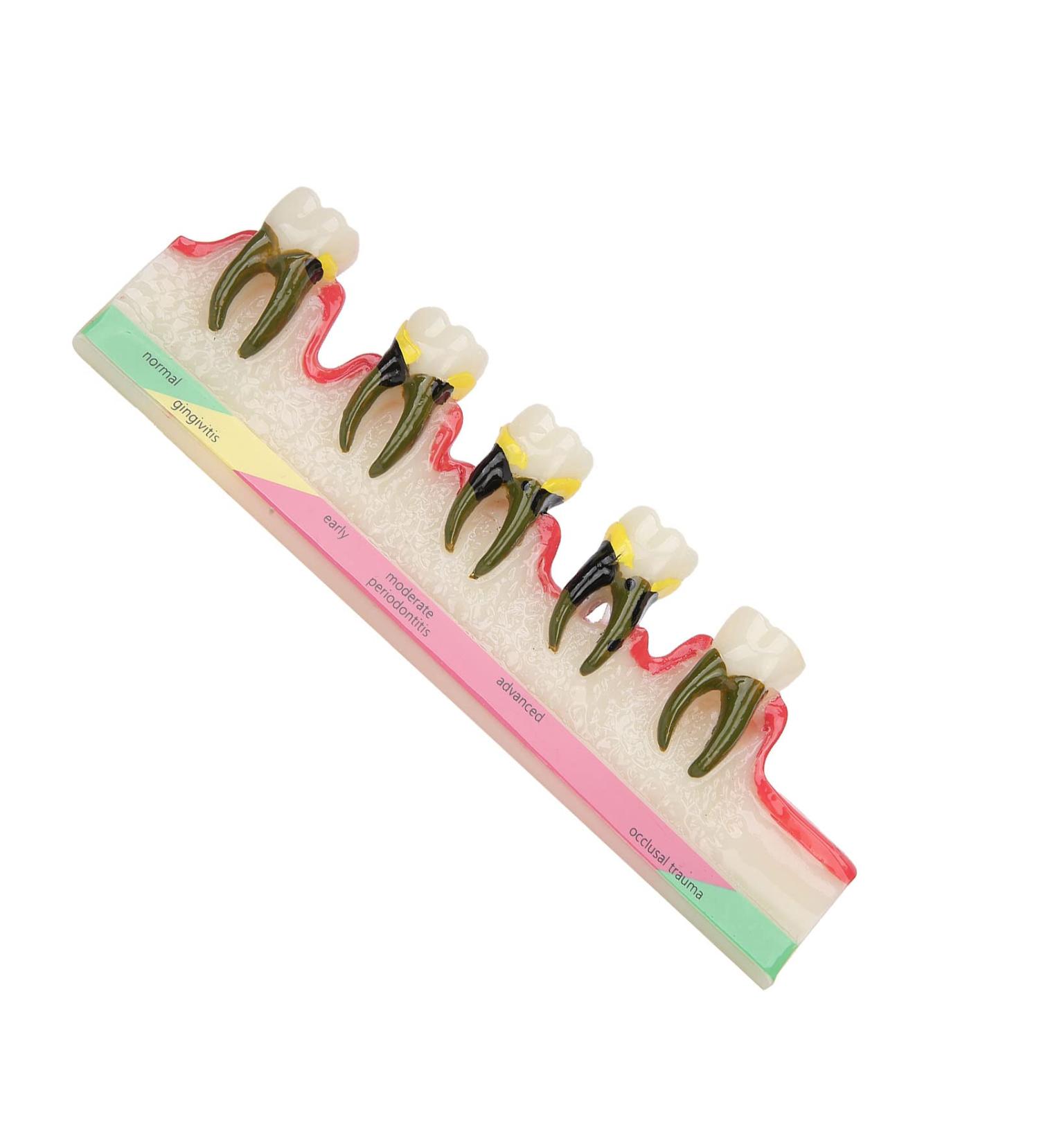 Shop Verdant Touch Tooth Model - Dental Periodontal Disease Study Tool for Schools | International Shipping Available - Buy Online on GoSupps.com