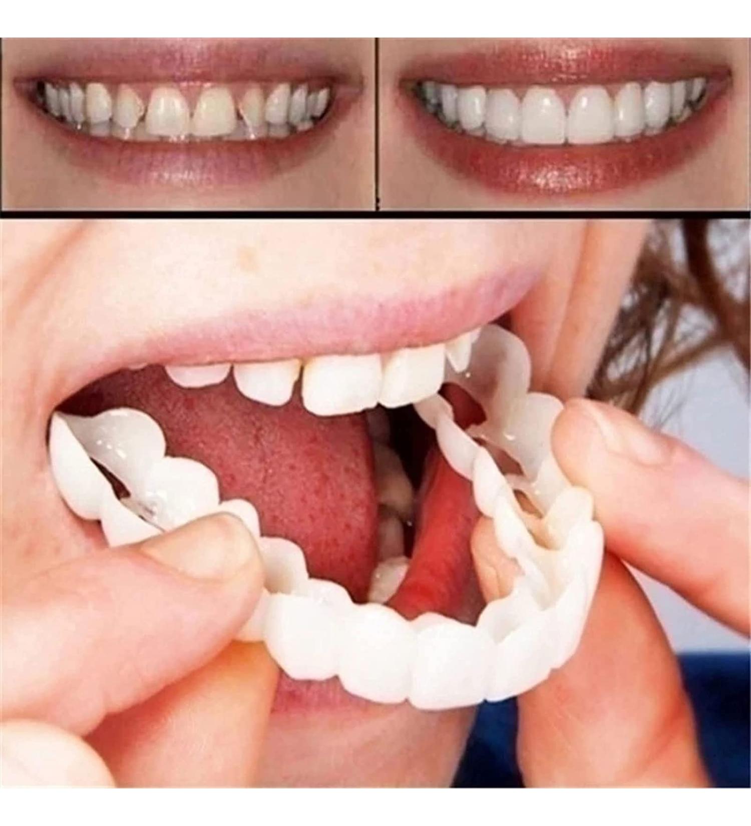 Instant Veneer Dentures Set - Serrated Top Bottom Fake Teeth for Men and Women - Buy Online on GoSupps.com