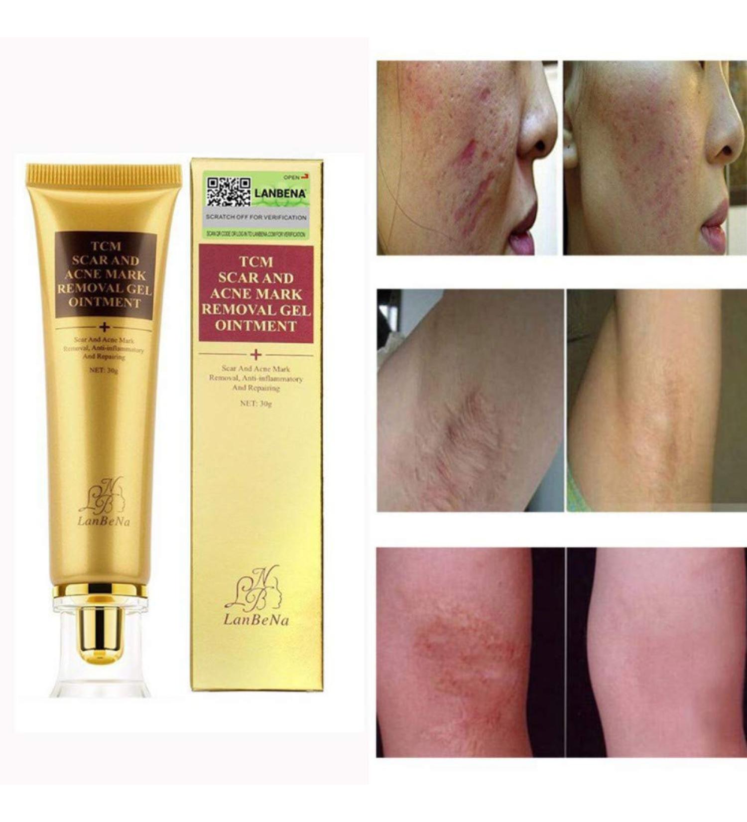 Symeas Scar & Acne Removal Cream - Effective Treatment for Stretch Marks Keloid Skin & Burns - 30g - Buy Online on GoSupps.com