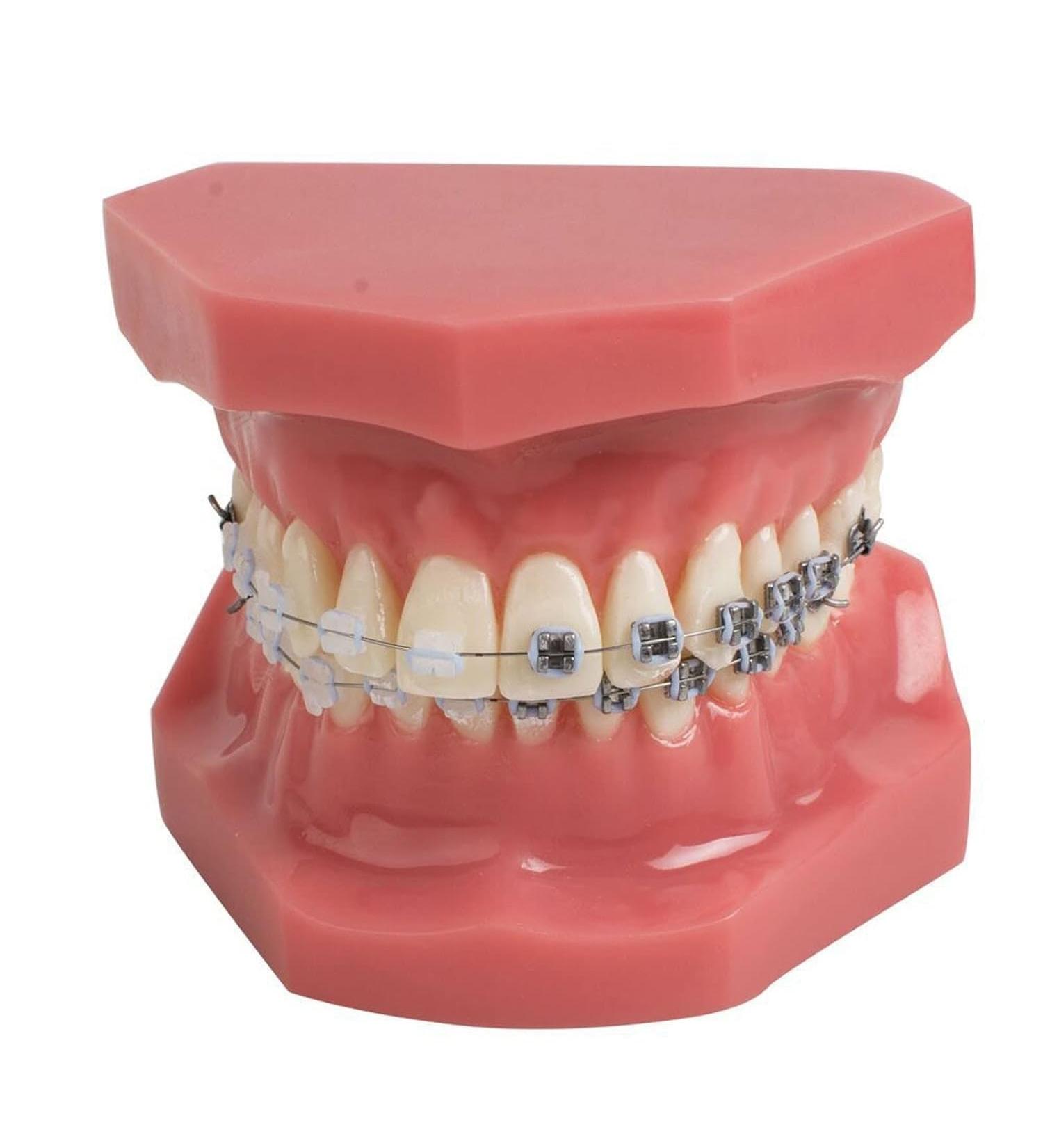 Dental Model Dentist Orthodontic Teeth Demonstration Model Orthodontic Dental Model with Ceramic Brackets and Metal Bracket for Learning Teaching Research - Buy Online on GoSupps.com