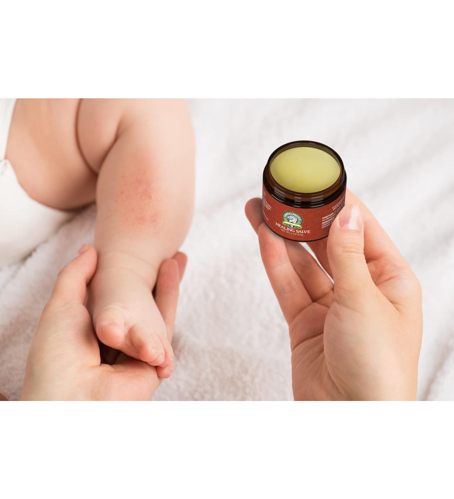 Sandalwood's Organics Healing Salve - Natural Calendula Ointment for Baby | Diaper Rash, Minor Burn, Chafing Relief | Moisturizing Balm with Marigold, Lavender, Coconut Oil, Beeswax - Yellow - Buy Online on GoSupps.com