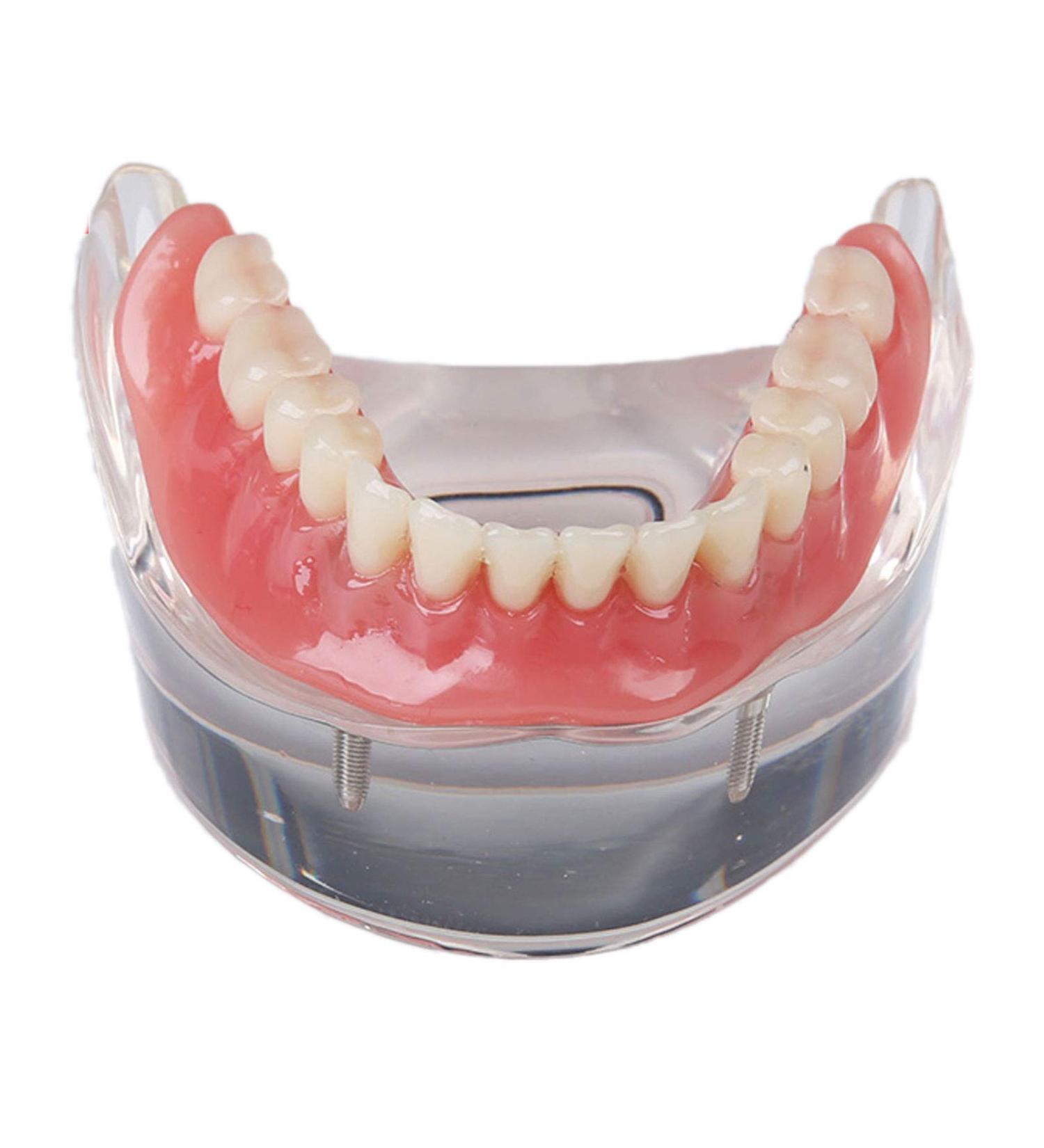 Dental Teeth Model - Lower Removable Overdenture with 2 Implants | Dentist Assistant Supplies - International Shipping - Buy Online on GoSupps.com