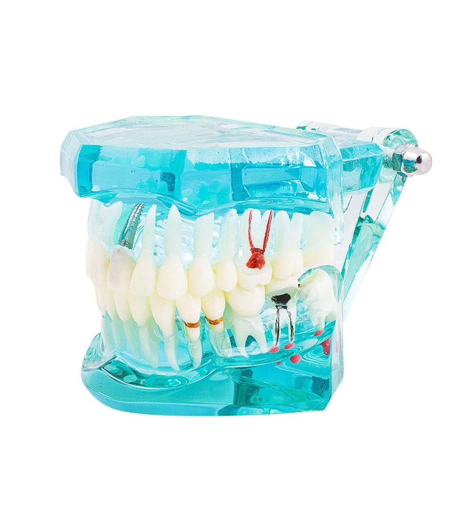 Buy Lmeil Transparent Dental Teeth Model - Ideal for Implantation & Dentist Research | Pathological Dental Model - Buy Online on GoSupps.com