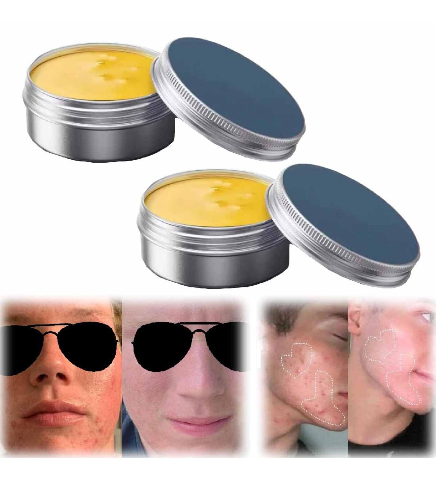 TSYIDUI Acne & Redness KillerAcne BalmRedness Relief BalmGentle Acne Face CreamAcne Remove Skin Care SetAcne Clearing Cream For Teens AdultsSkin Soothing Cream 2pcs - Buy Online on GoSupps.com