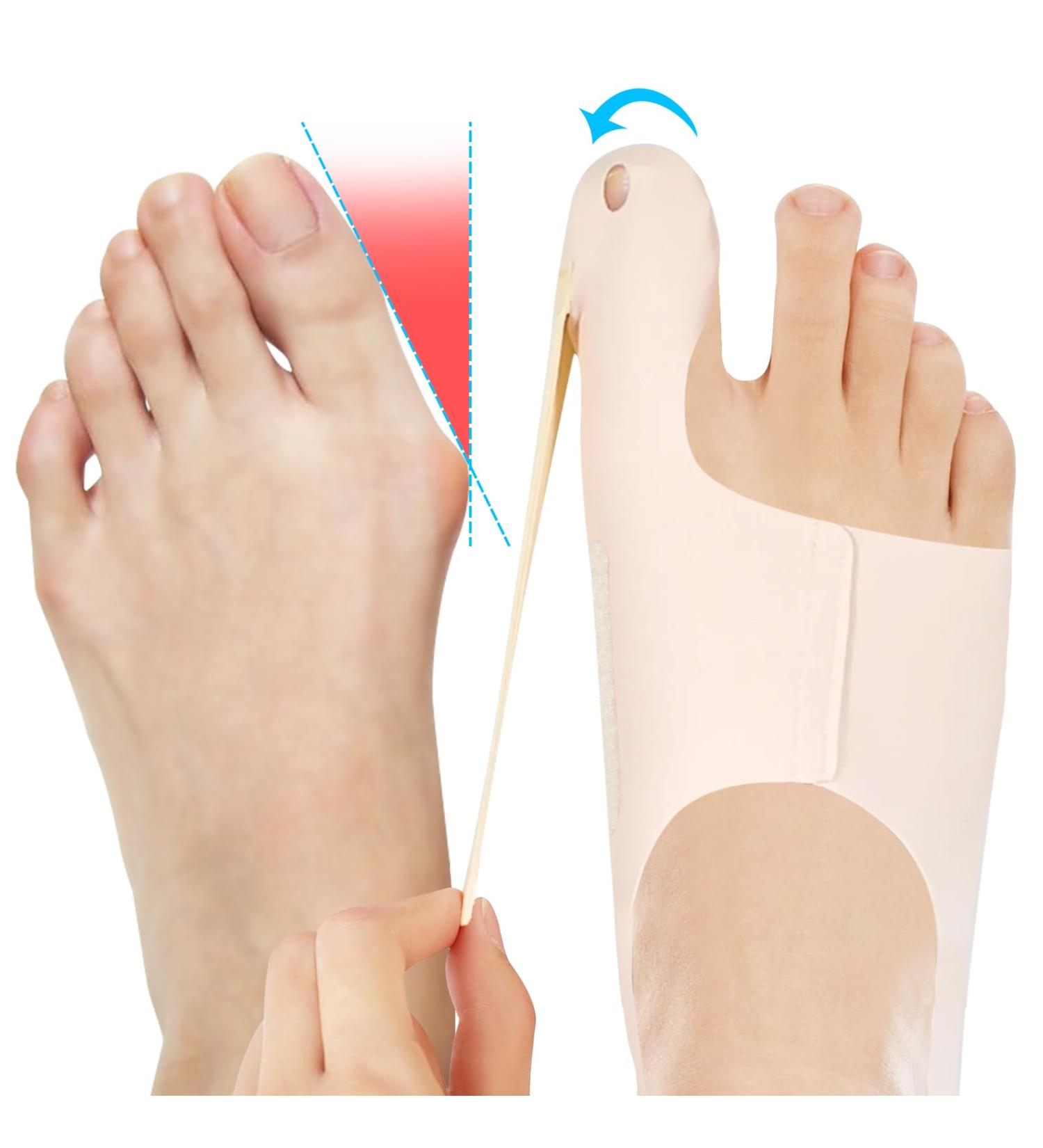 Soarfly Adjustable Hallux Valgus Correction Rail - Pain Relief Bandage for Day & Night Use | Non-Slip Heel Strap | Effective Treatment for Foot Problems - Buy Online on GoSupps.com