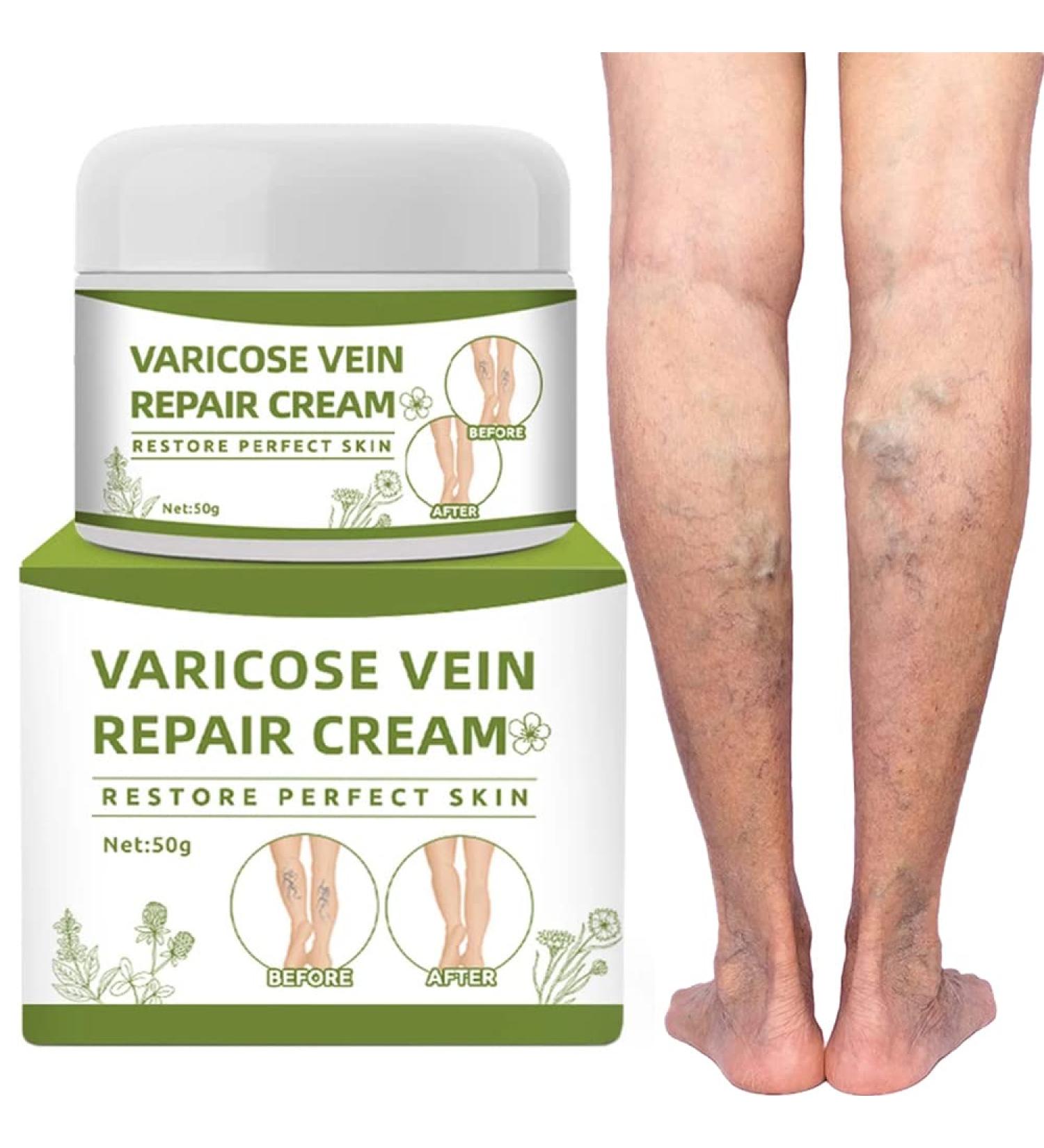 Varicose Veins Cream - Repair Spider Veins & Leg Treatment (50g) | Effective Relief for Healthy Legs - Buy Online on GoSupps.com