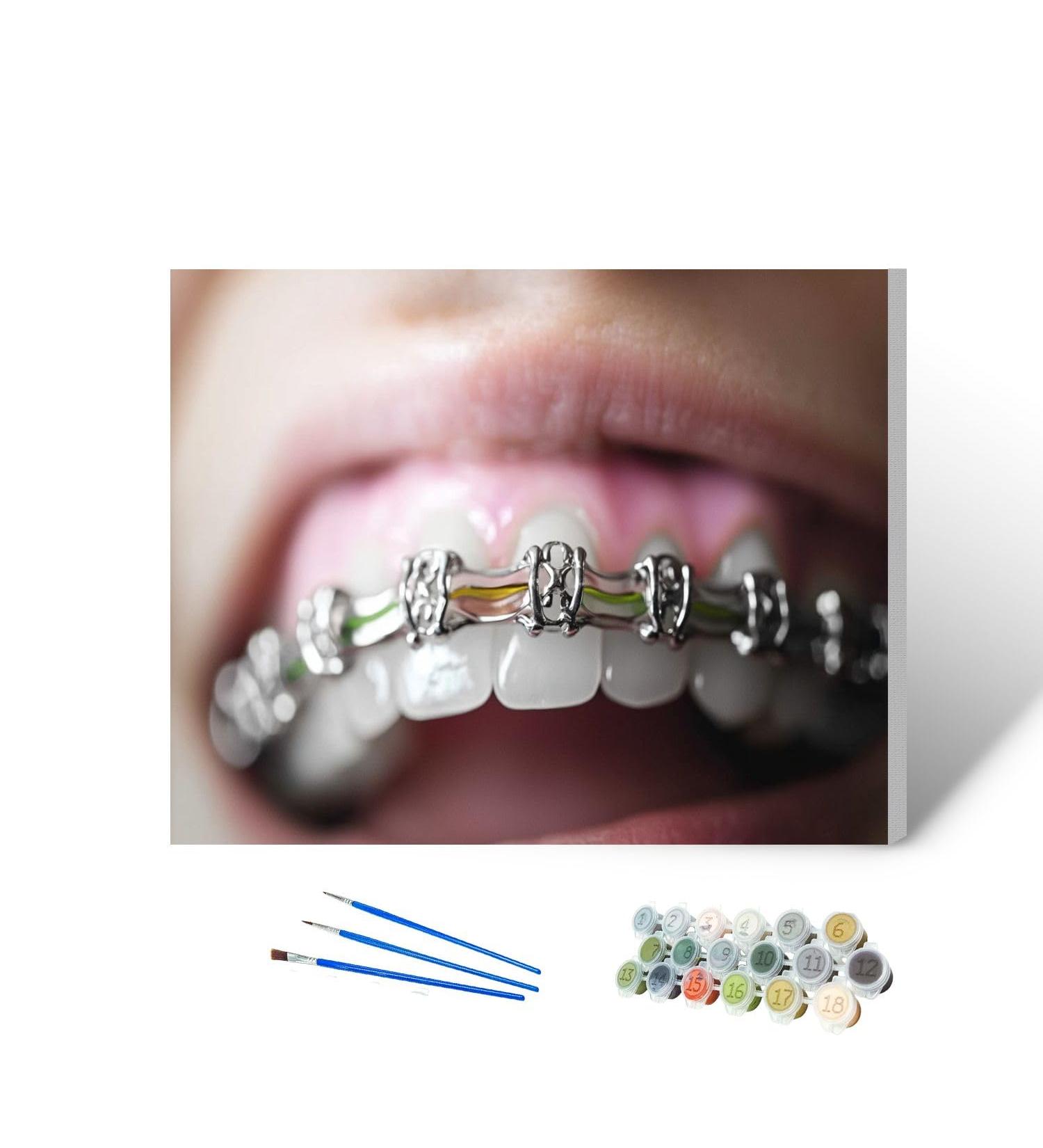 Paint by Numbers Kit for Adults cosmetic dentistry orthodontics dental metal wire teeth brackets 16x20" DIY Color by Numbers Acrylic Paint Framed Canvas Painting Kits for Beginner Students Teens Color5 16 x 20 inches - Buy Online on GoSupps.com
