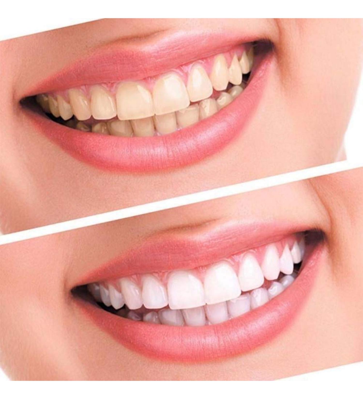 Henylas Tooth Whitening Stripes - Pain-Free Home Bleaching Kit | 14 Professional Strips for Brightening Teeth - Buy Online on GoSupps.com